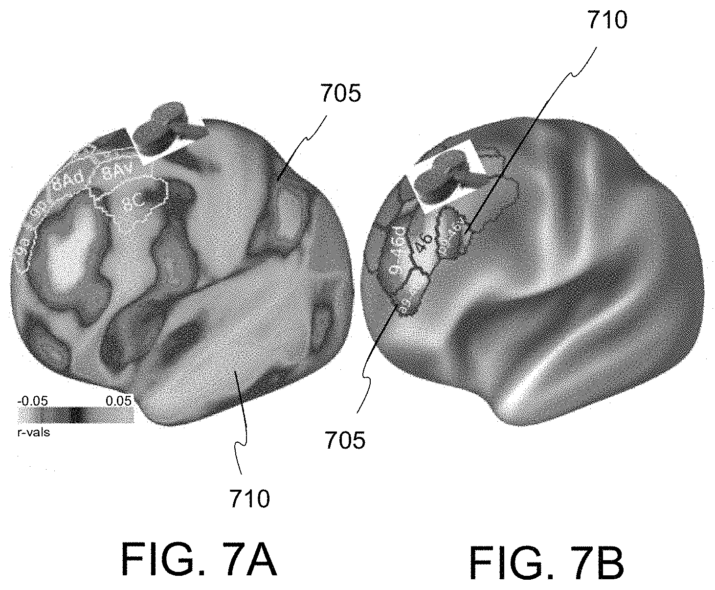 Patent US11779218 Figure 11 – System, method and computer-accessible medium for predicting response to electroconvulsice therapy based on brain functional connectivity patterns