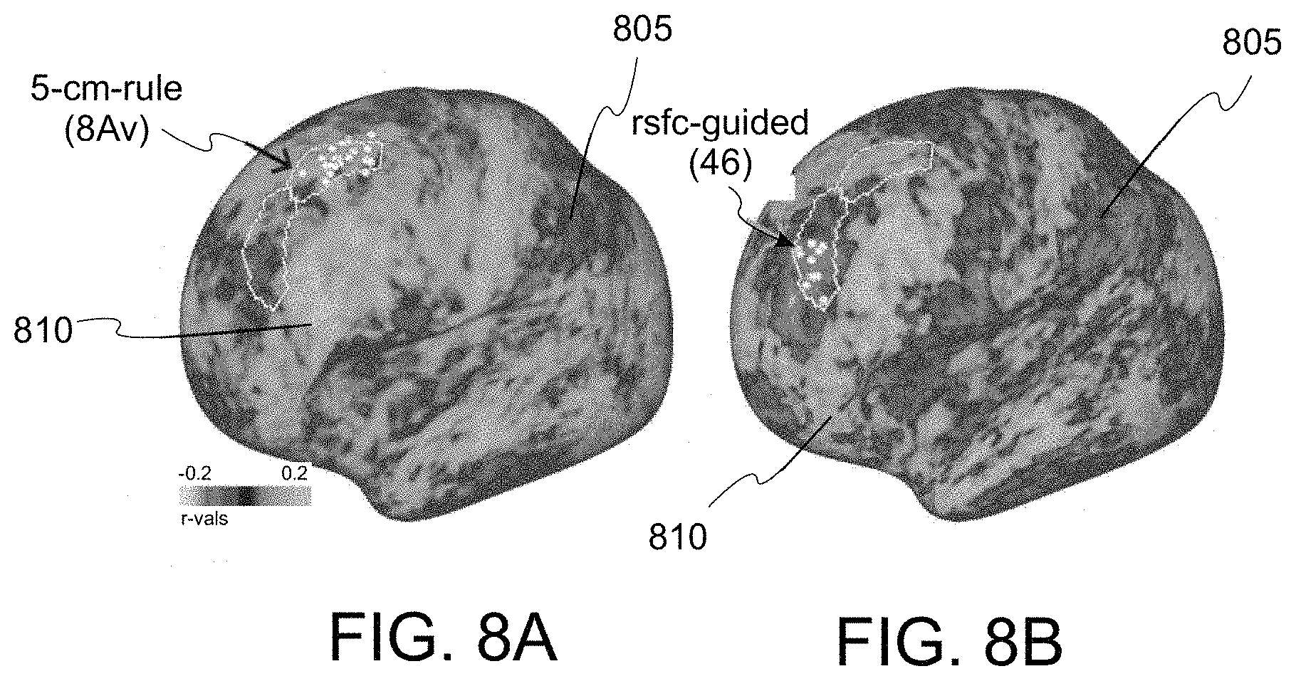 Patent US11779218 Figure 12 – System, method and computer-accessible medium for predicting response to electroconvulsice therapy based on brain functional connectivity patterns