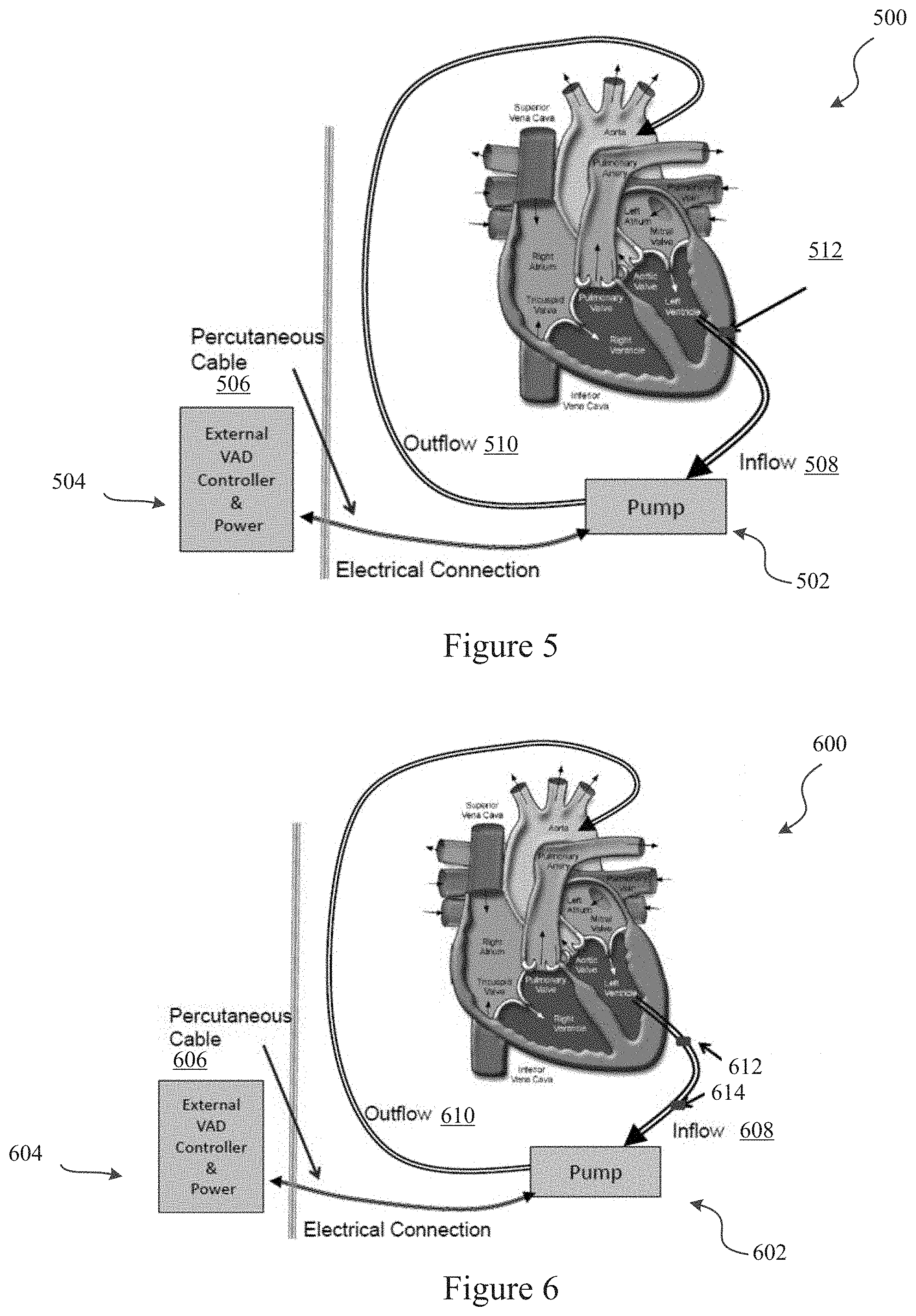 Patent US11779234 Figure 4 – Pressure sensing ventricular assist devices and methods of use