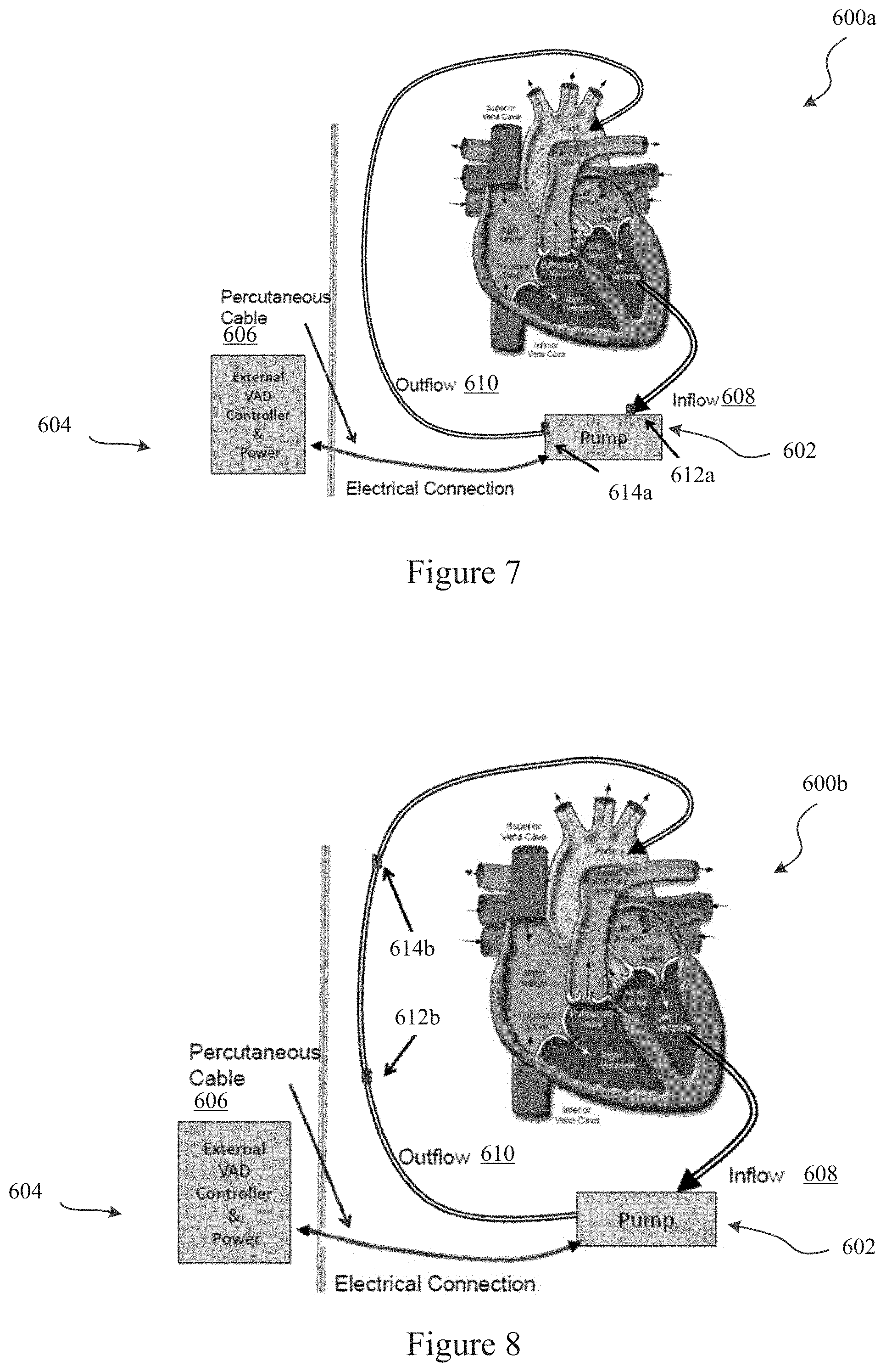 Patent US11779234 Figure 5 – Pressure sensing ventricular assist devices and methods of use
