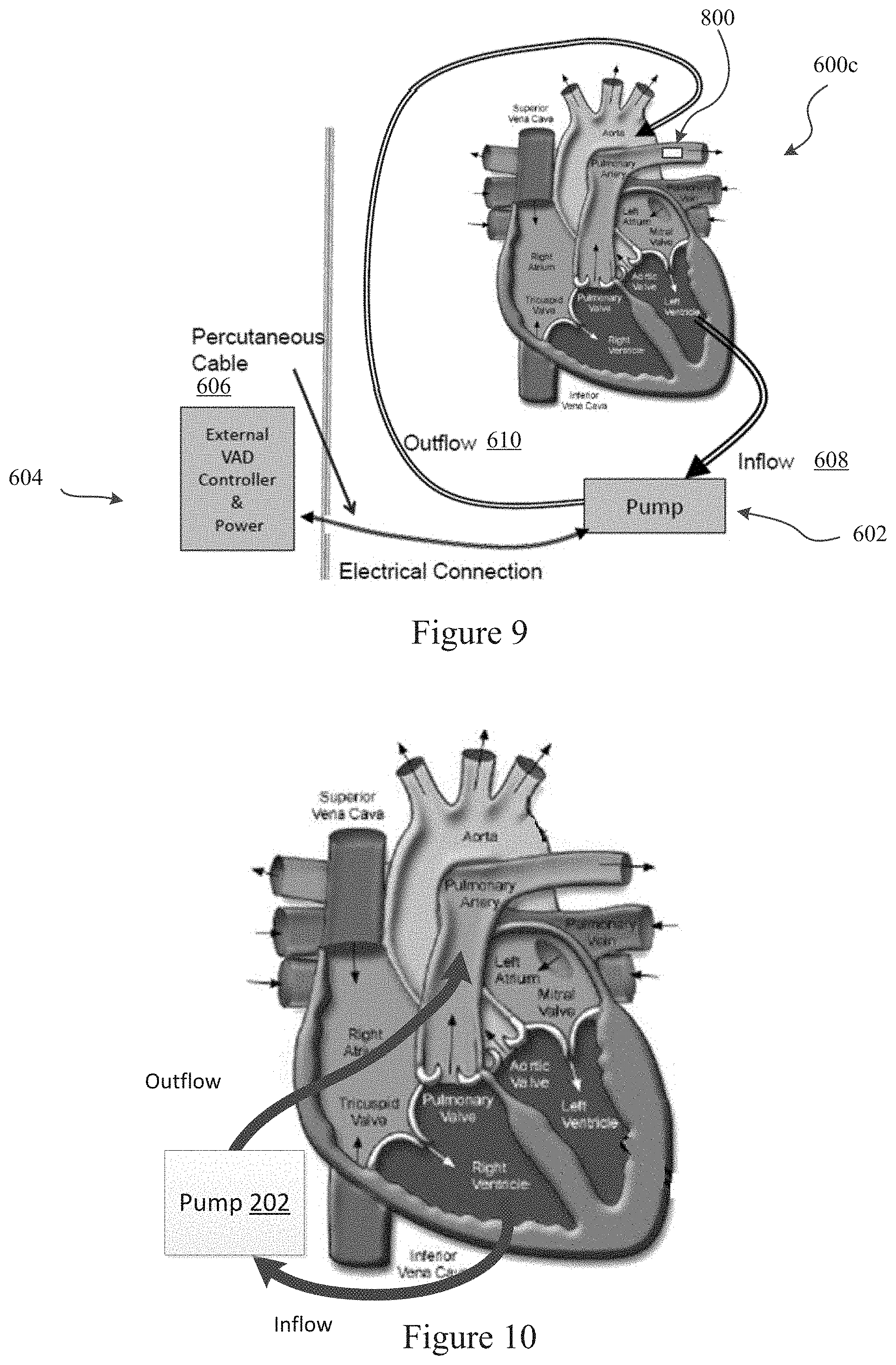 Patent US11779234 Figure 6 – Pressure sensing ventricular assist devices and methods of use