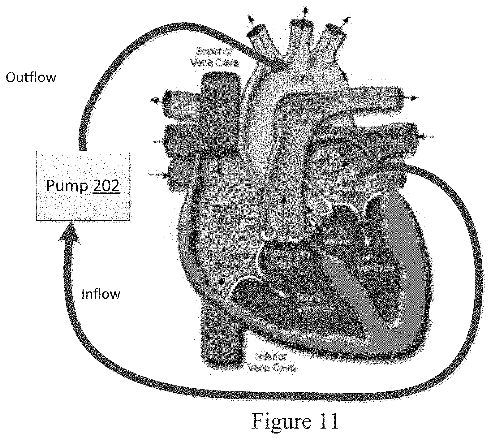 Patent US11779234 Figure 7 – Pressure sensing ventricular assist devices and methods of use