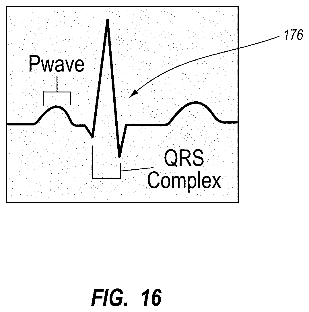 Patent US11779240 Figure 17 – Systems and methods for breaching a sterile field for intravascular placement of a catheter
