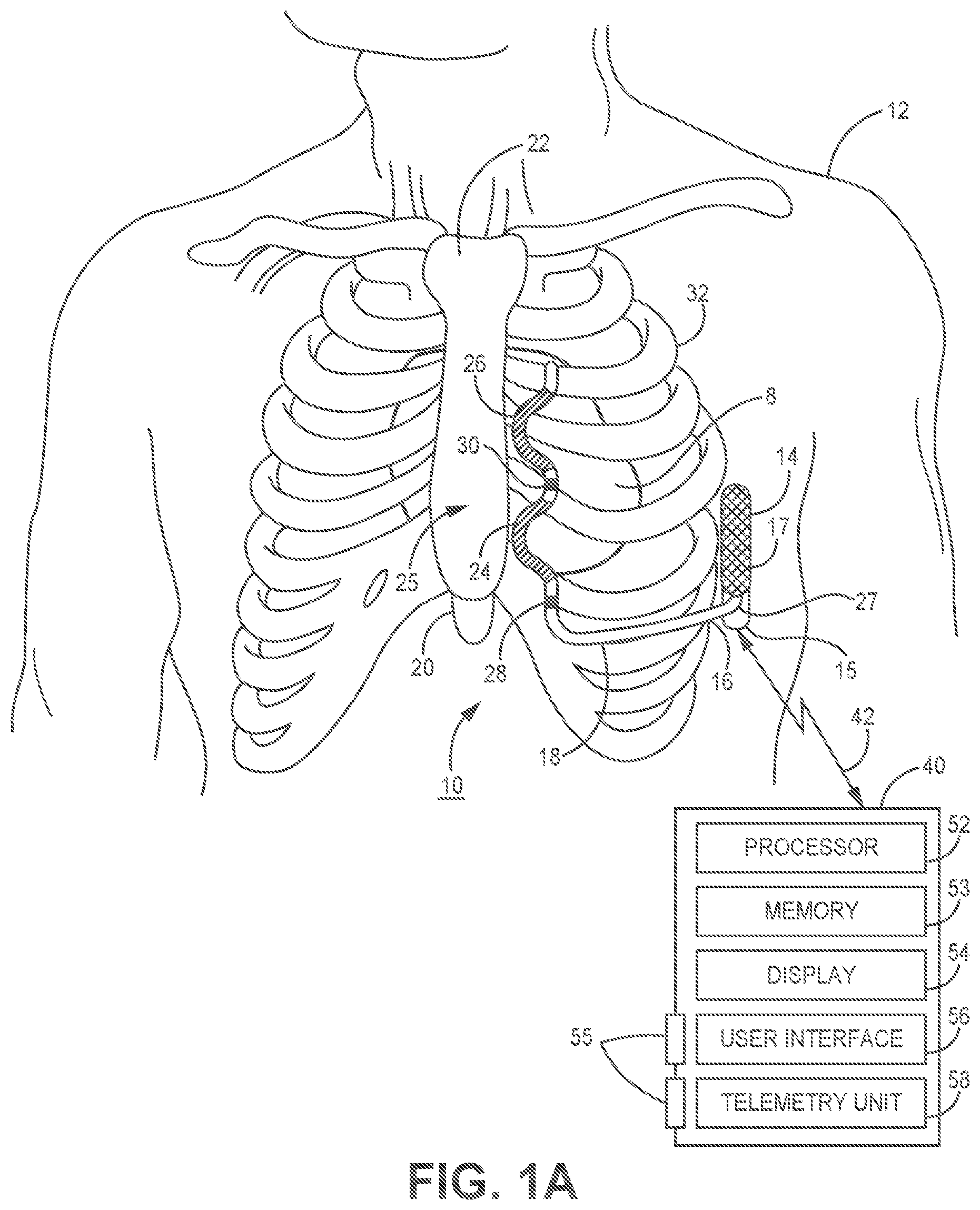 Patent US11779255 — Medical device and method for predicting cardiac event sensing based on sensing control parameters — Figure 1