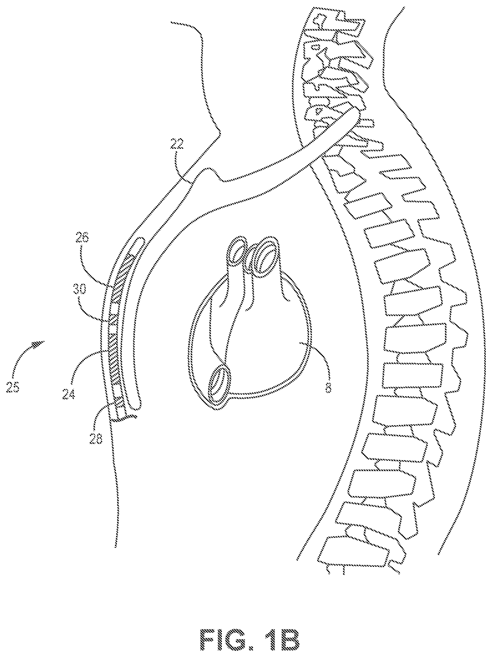 Patent US11779255 Figure 2 – Medical device and method for predicting cardiac event sensing based on sensing control parameters