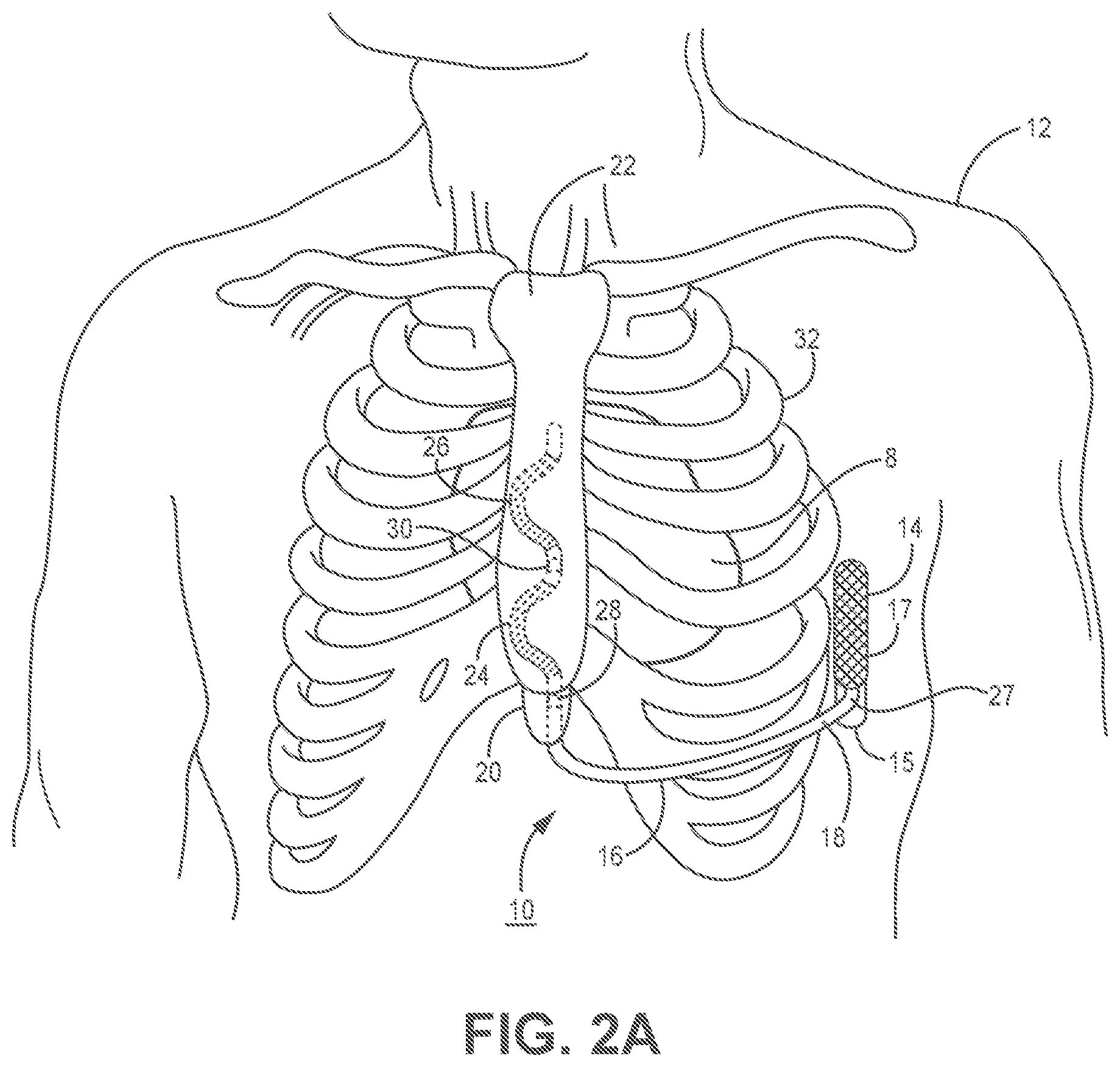 Patent US11779255 Figure 3 – Medical device and method for predicting cardiac event sensing based on sensing control parameters