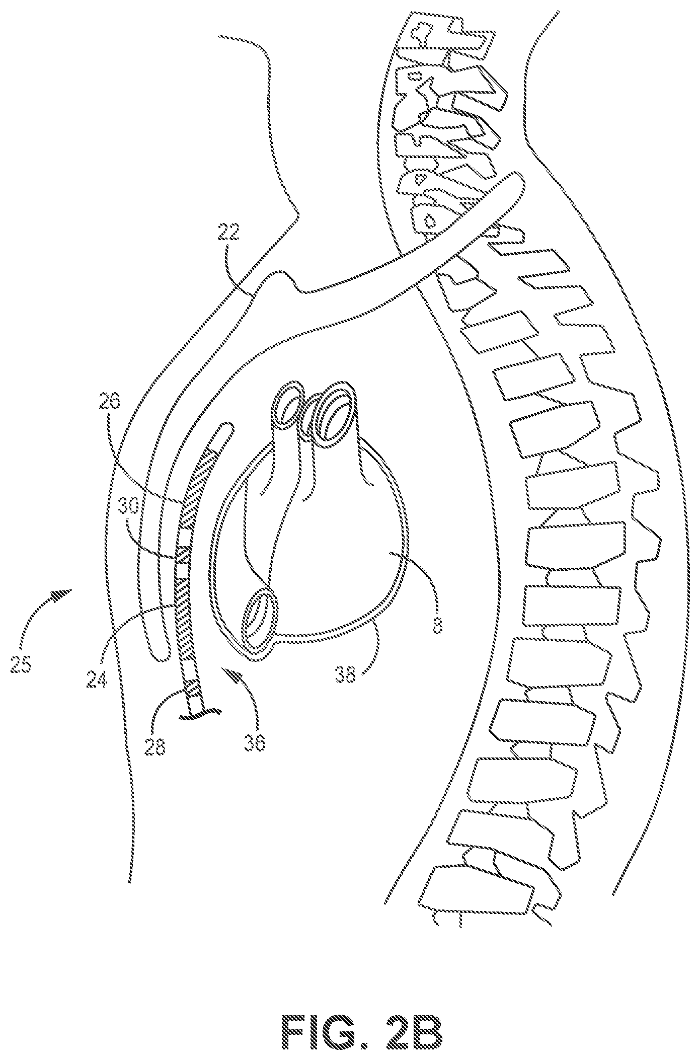 Patent US11779255 Figure 4 – Medical device and method for predicting cardiac event sensing based on sensing control parameters