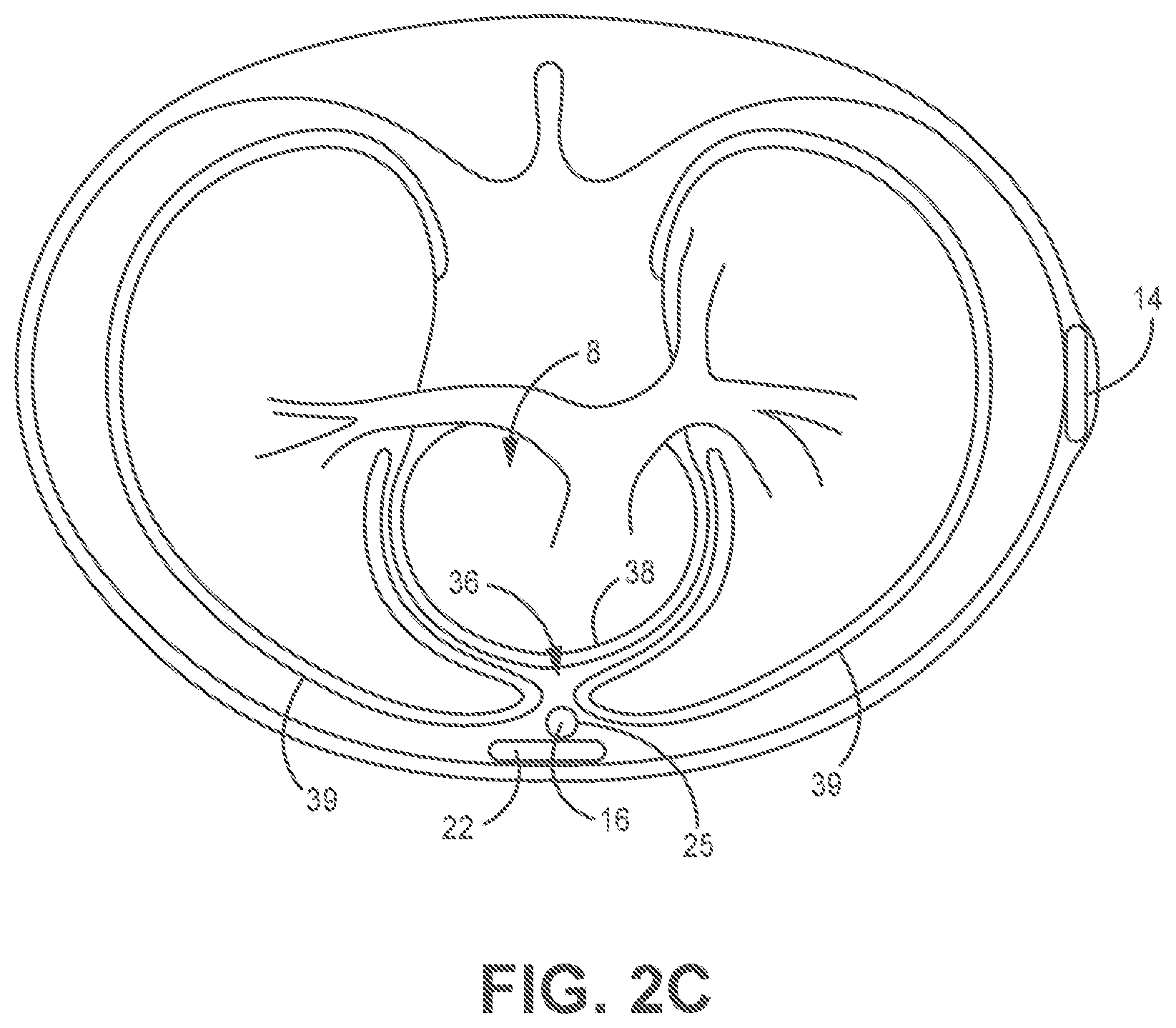 Patent US11779255 Figure 5 – Medical device and method for predicting cardiac event sensing based on sensing control parameters