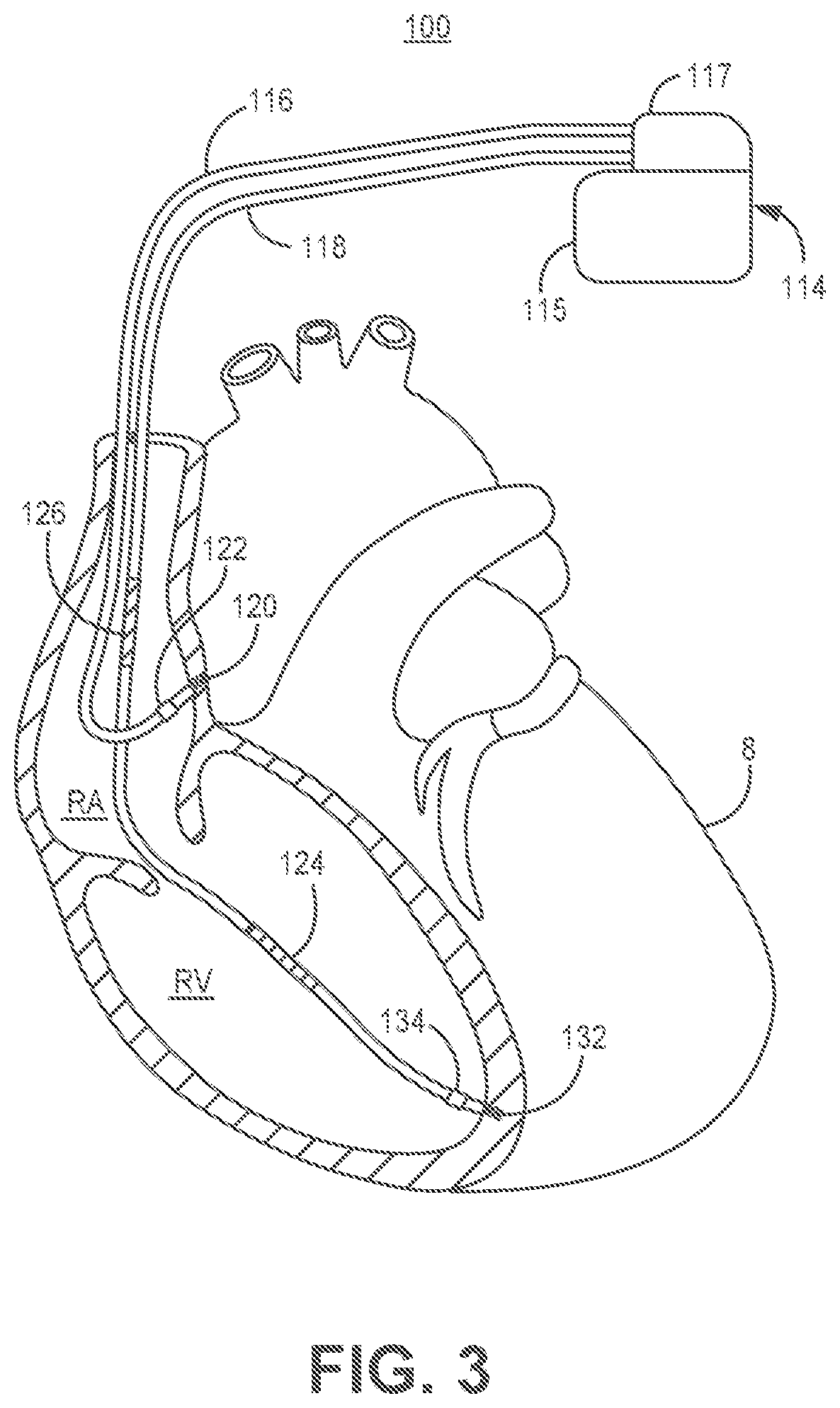 Patent US11779255 Figure 6 – Medical device and method for predicting cardiac event sensing based on sensing control parameters