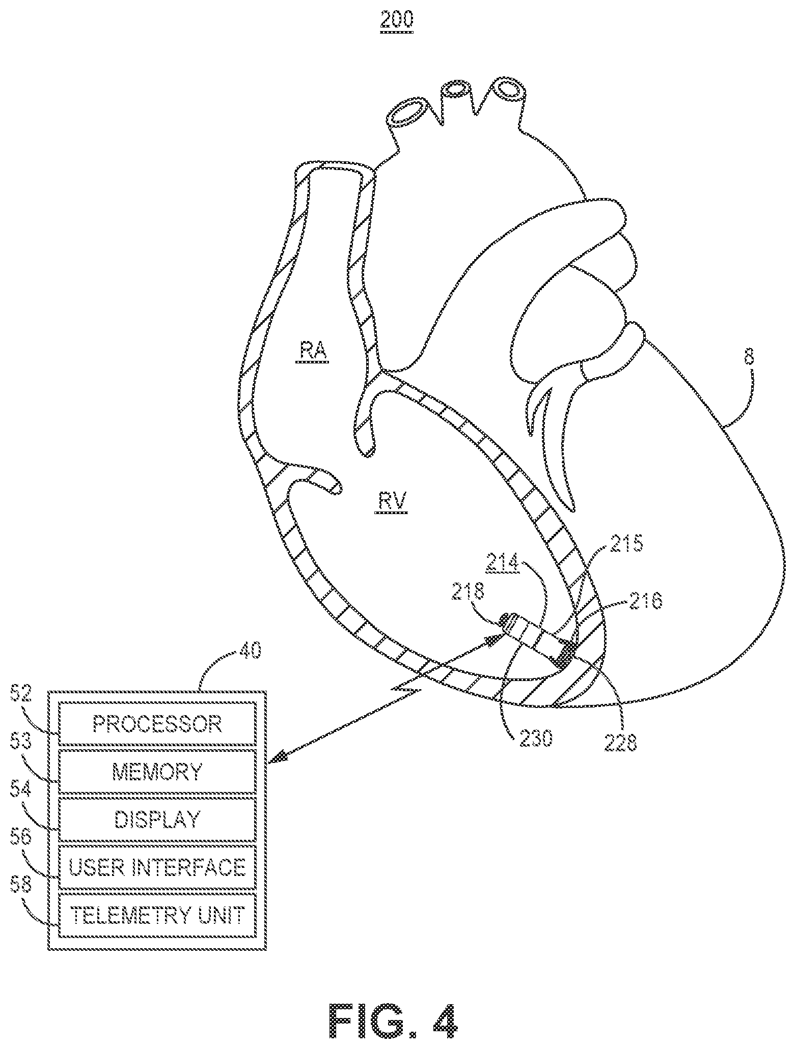 Patent US11779255 Figure 7 – Medical device and method for predicting cardiac event sensing based on sensing control parameters