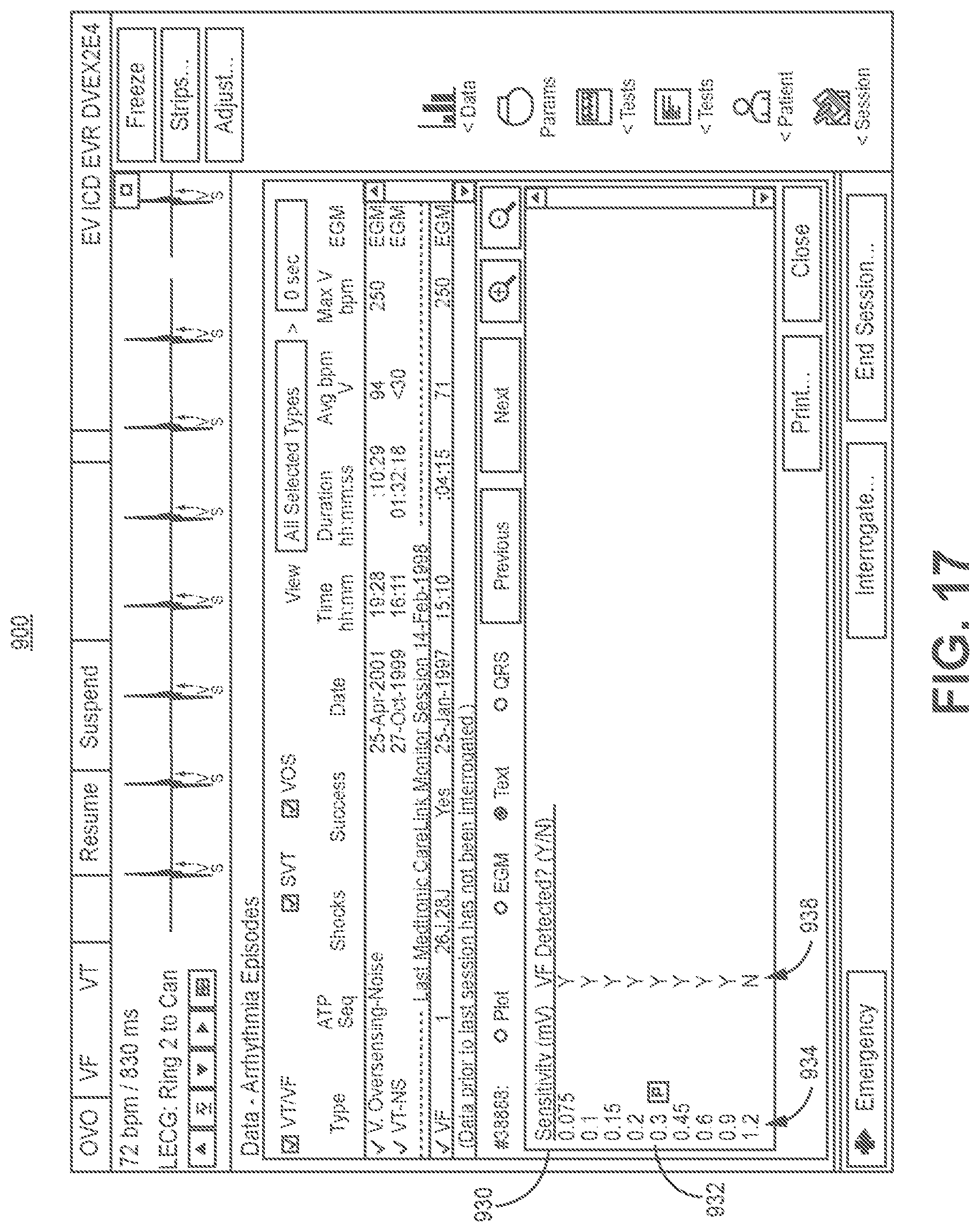 Patent US11779255 Figure 20 – Medical device and method for predicting cardiac event sensing based on sensing control parameters