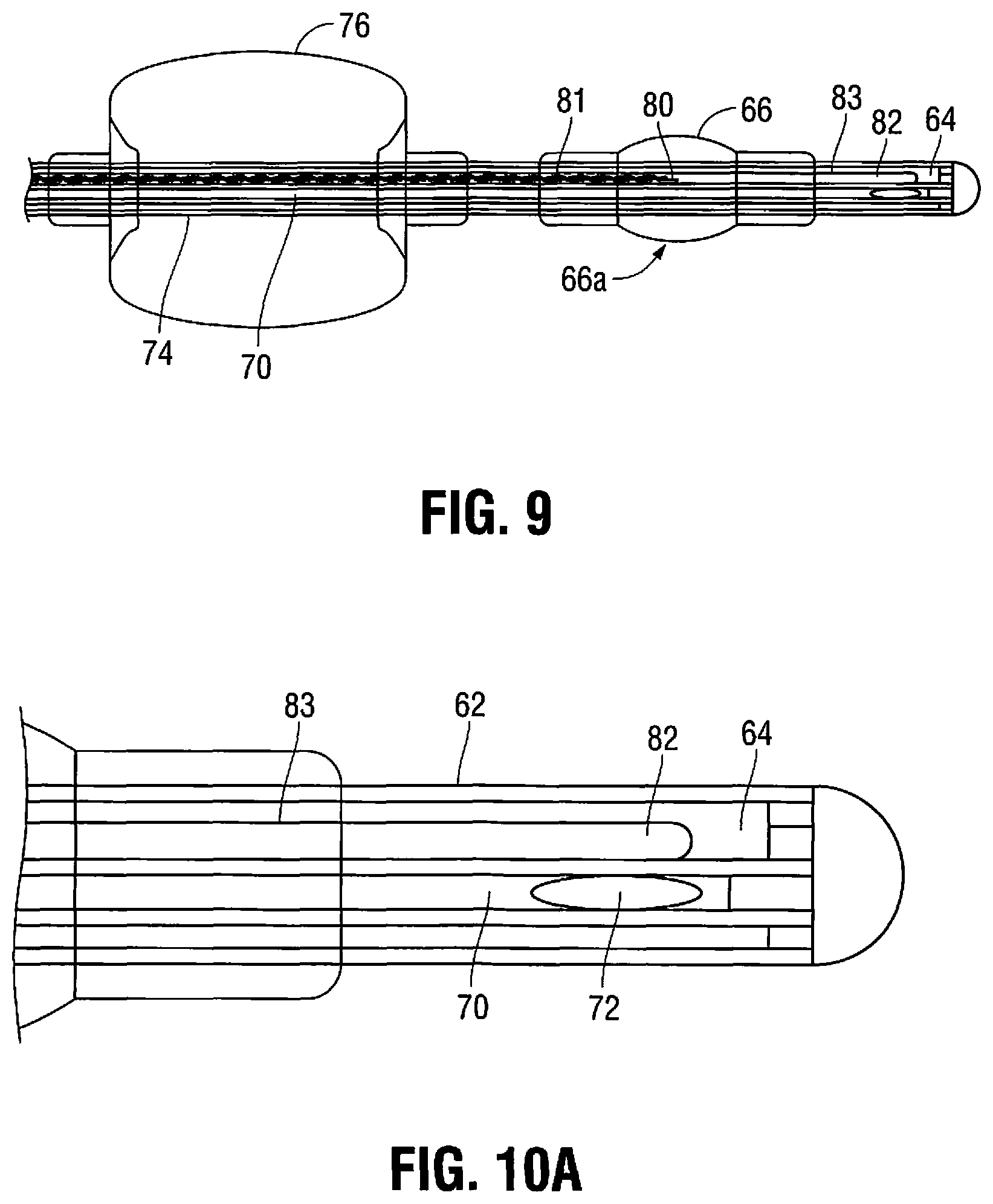 Patent US11779263 Figure 6 – Catheter for monitoring intra-abdominal pressure for assessing preeclampsia