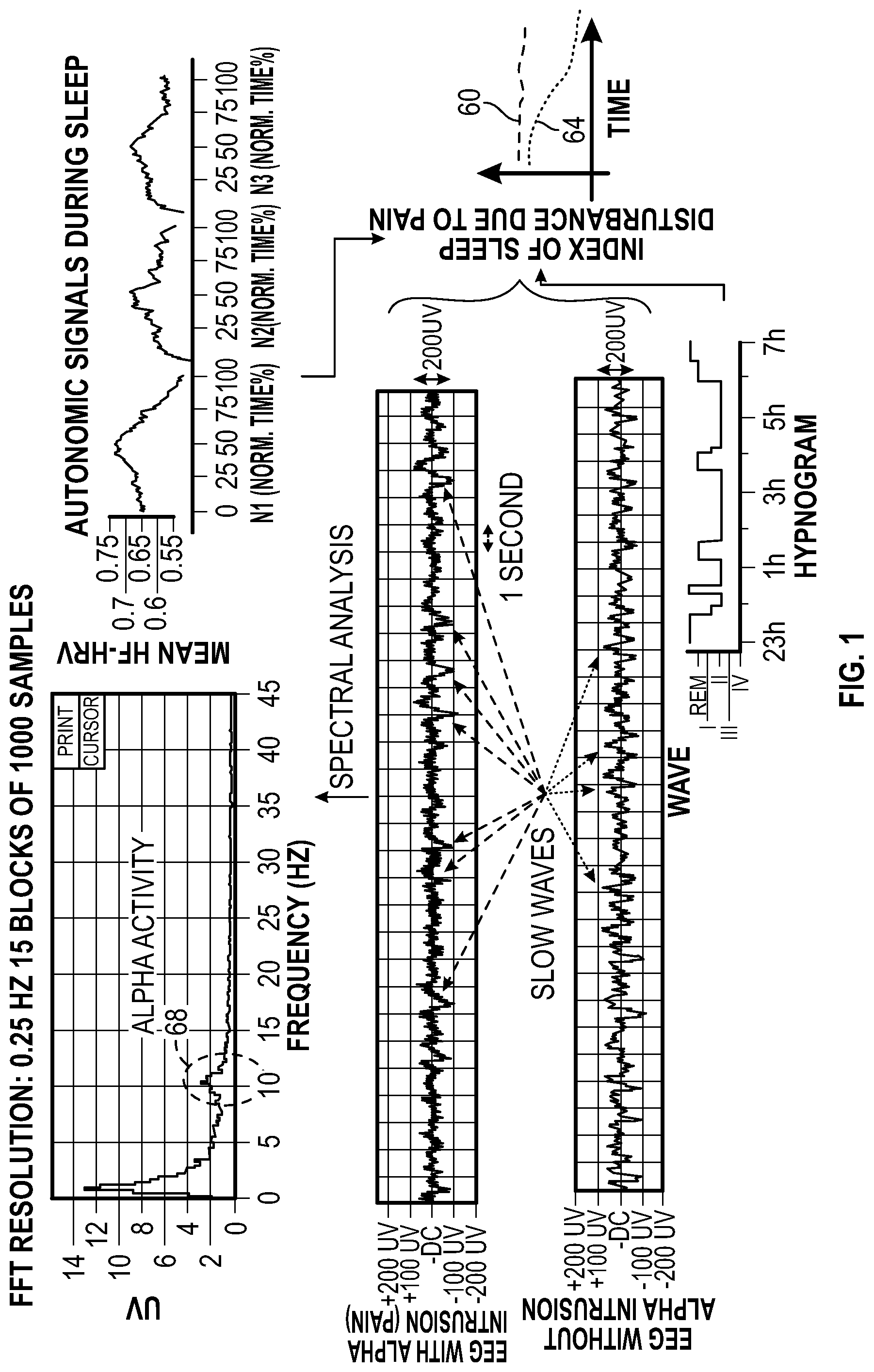 Patent US11779267 Figure 1 – Macro/micro-structure of sleep and similar states of consciousness to optimize pain treatment