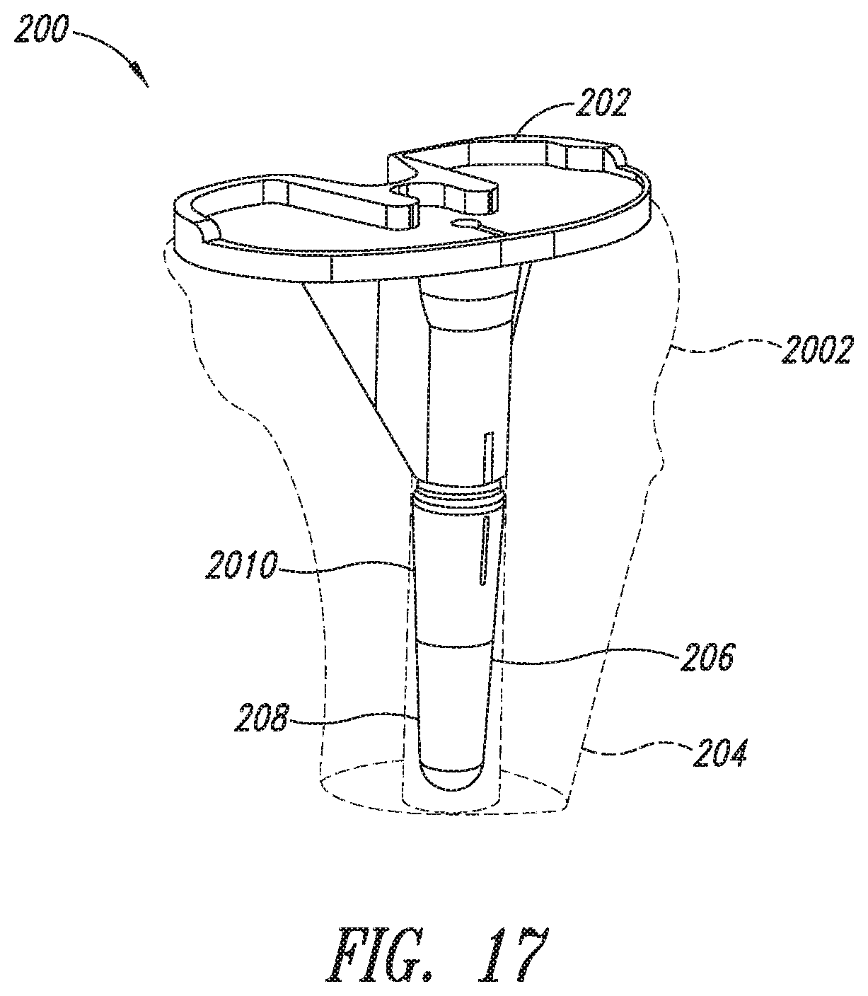 Patent US11779273 Figure 16 – Implantable reporting processor for an alert implant