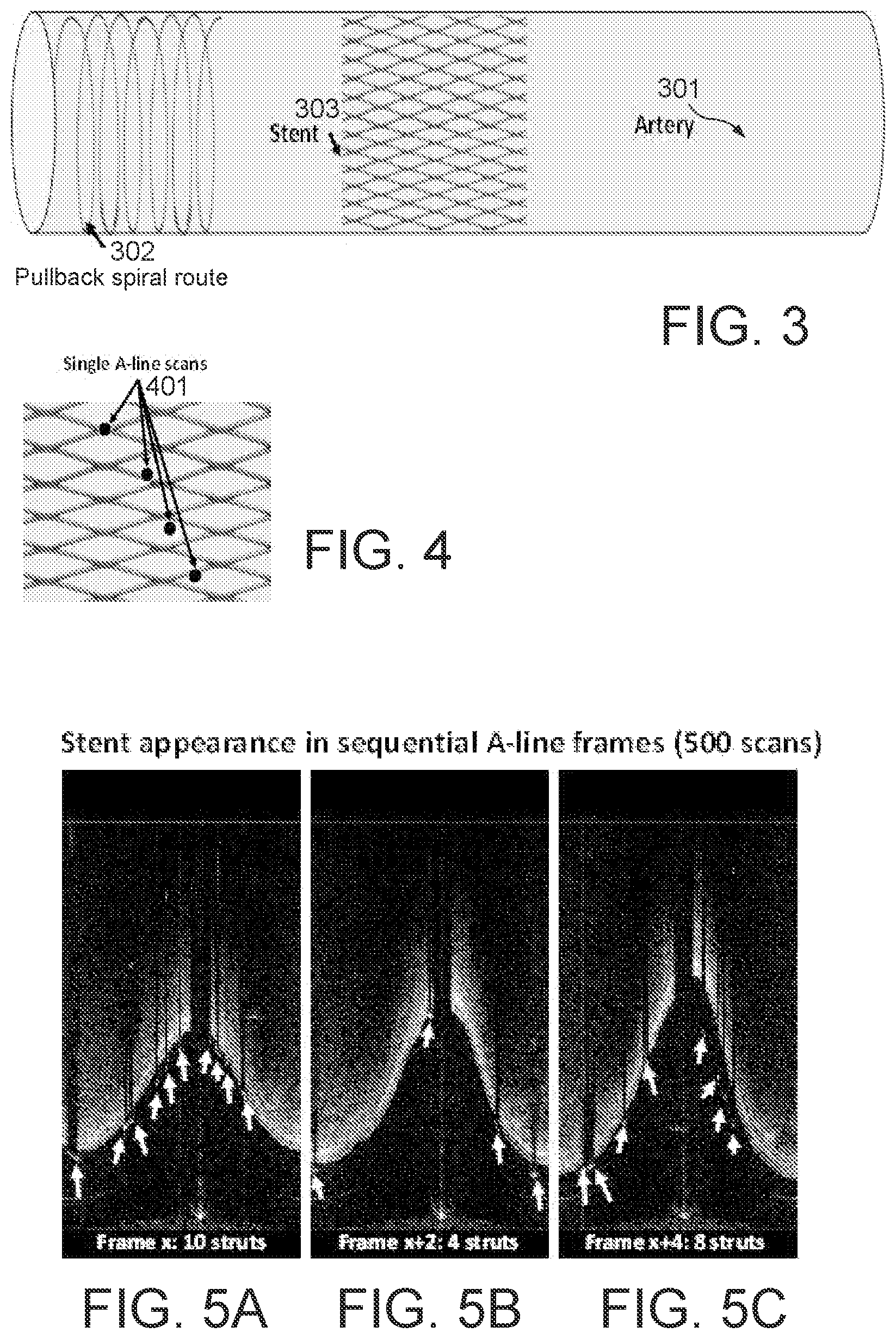Patent US11779277 Figure 3 – Systems and methods for endovascular device detection and apposition measurement