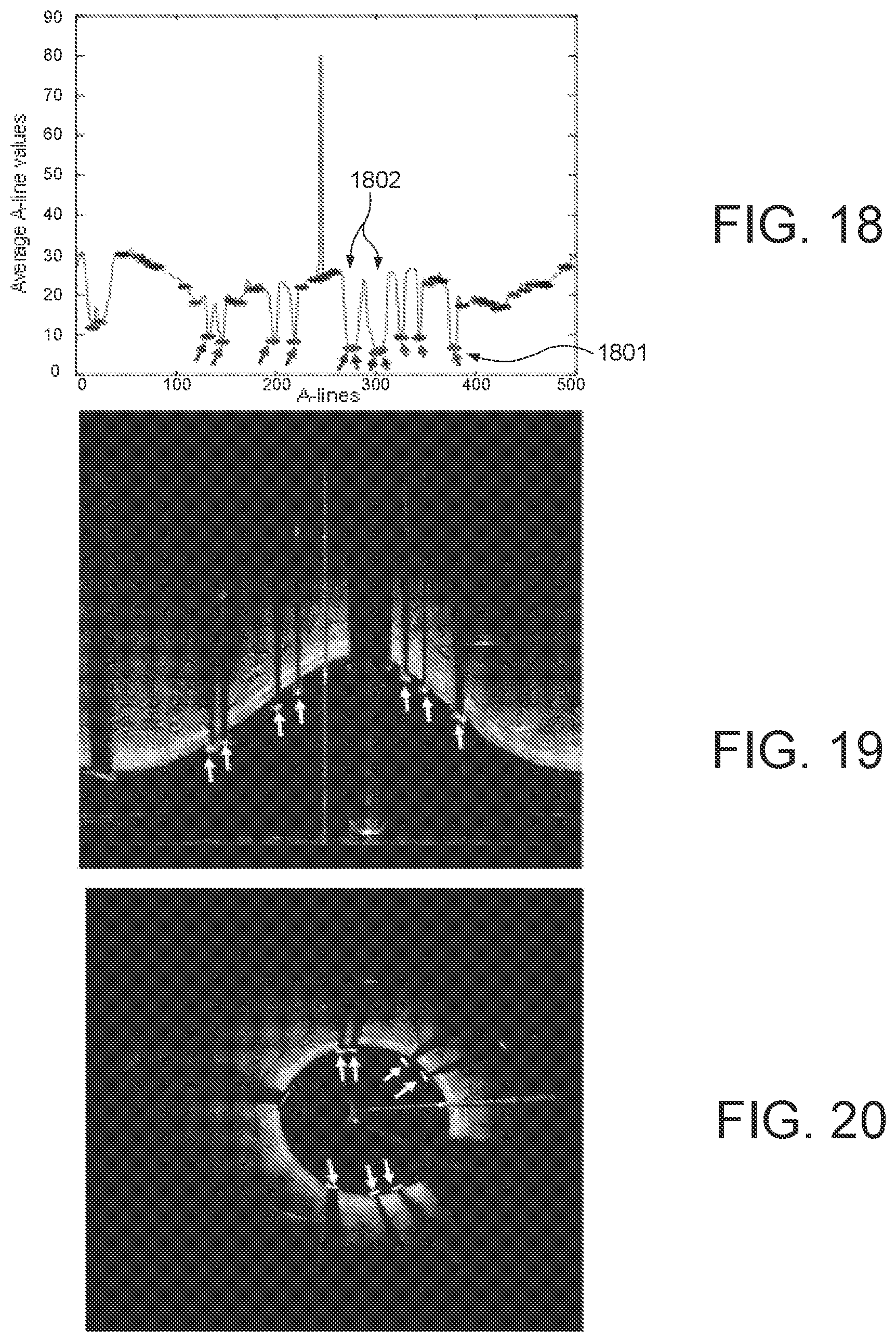 Patent US11779277 Figure 11 – Systems and methods for endovascular device detection and apposition measurement