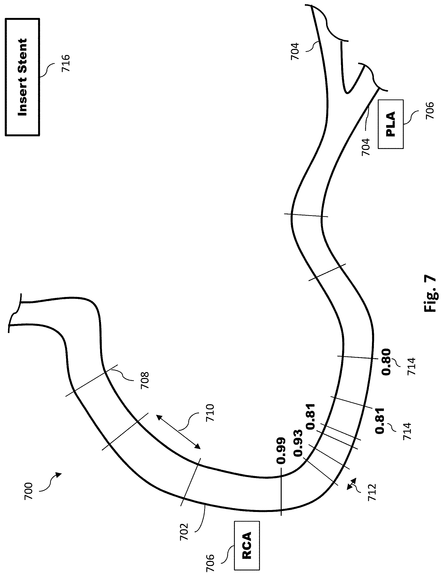 Patent US11779286 Figure 7 – Percutaneous coronary intervention (PCI) planning interface with pressure data and vessel data and associated devices, systems, and methods