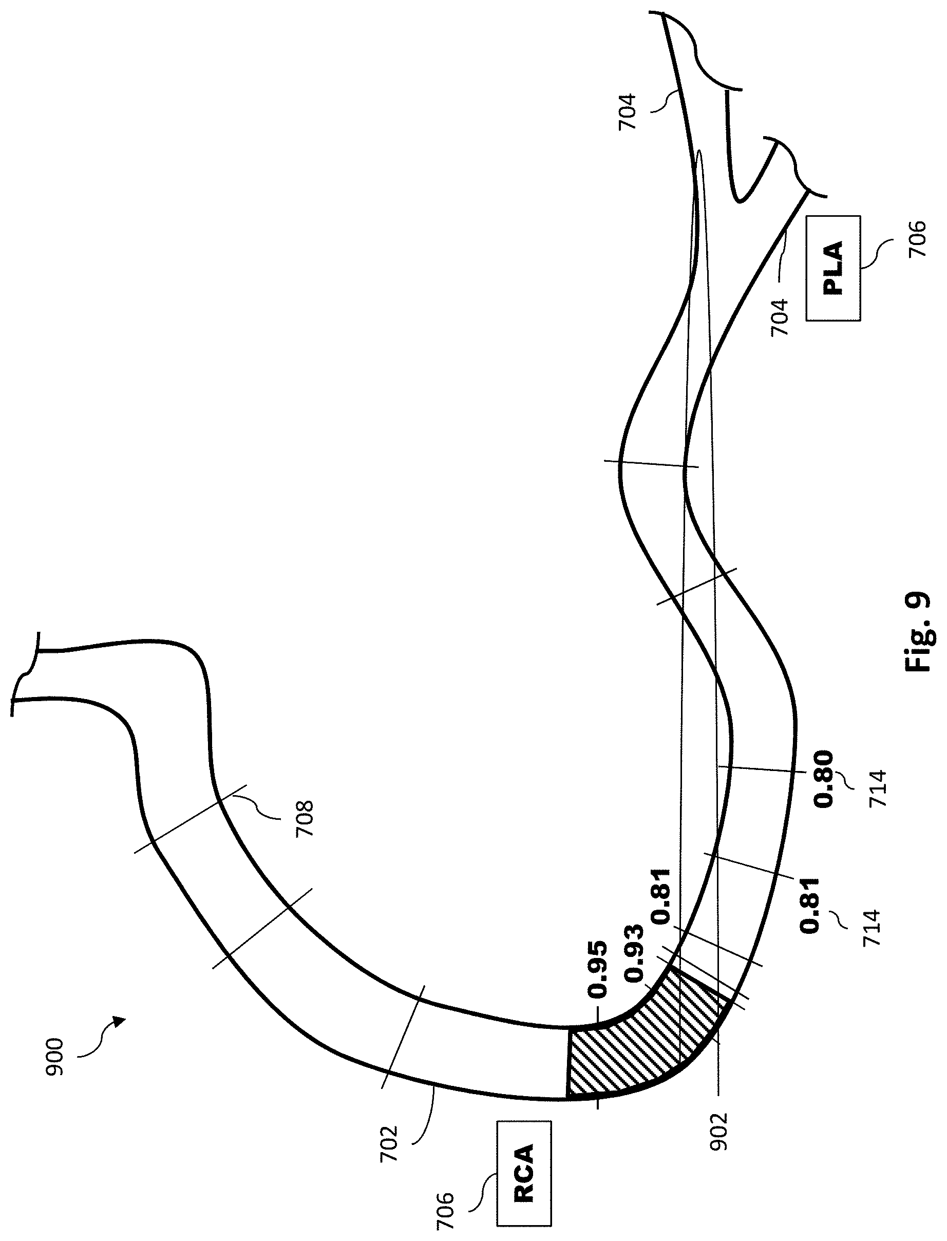 Patent US11779286 Figure 10 – Percutaneous coronary intervention (PCI) planning interface with pressure data and vessel data and associated devices, systems, and methods