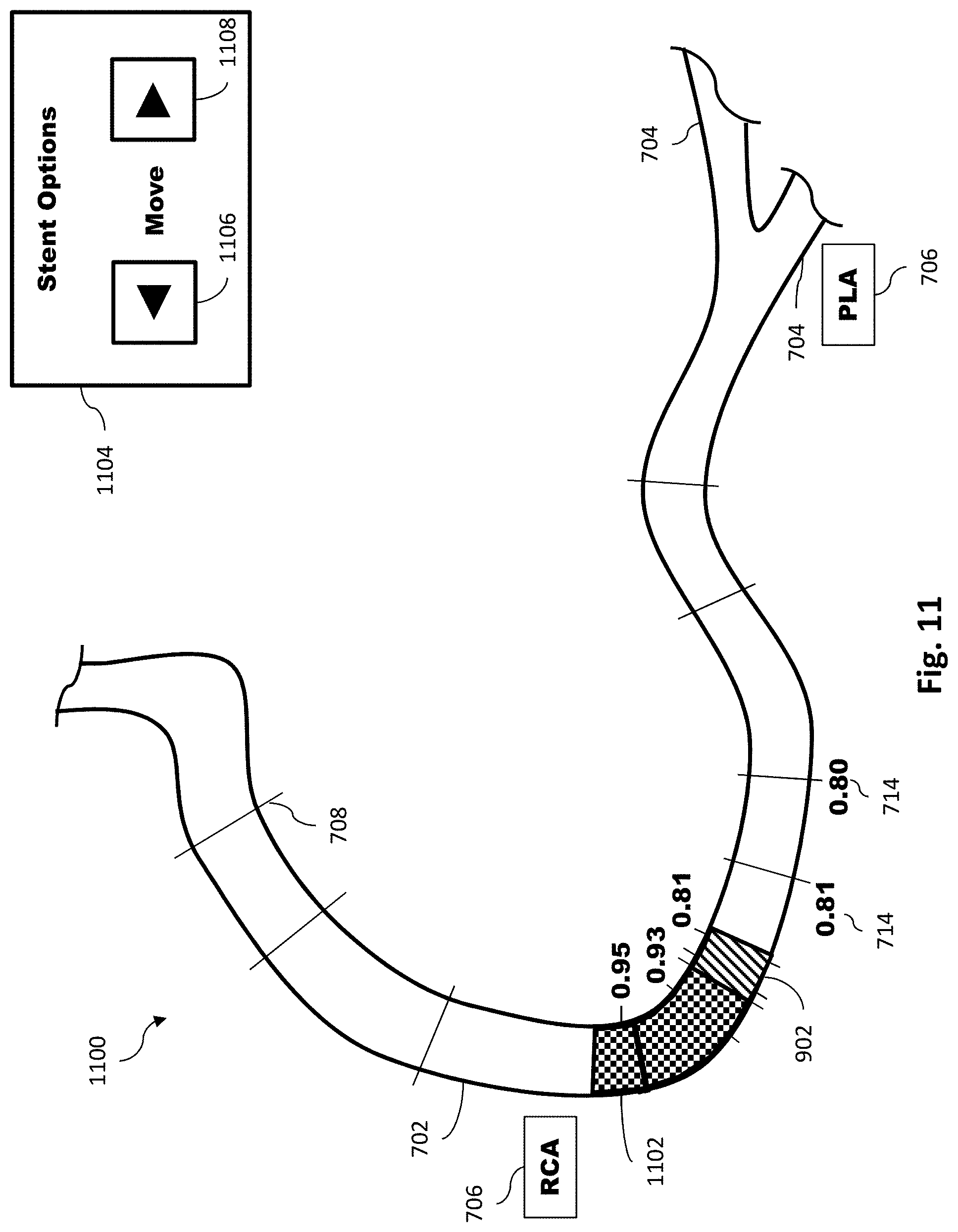 Patent US11779286 Figure 12 – Percutaneous coronary intervention (PCI) planning interface with pressure data and vessel data and associated devices, systems, and methods