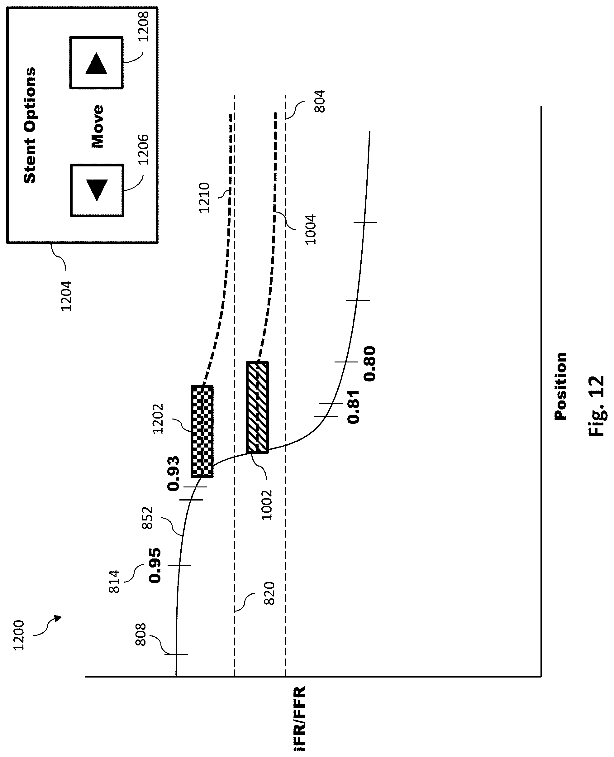 Patent US11779286 Figure 13 – Percutaneous coronary intervention (PCI) planning interface with pressure data and vessel data and associated devices, systems, and methods