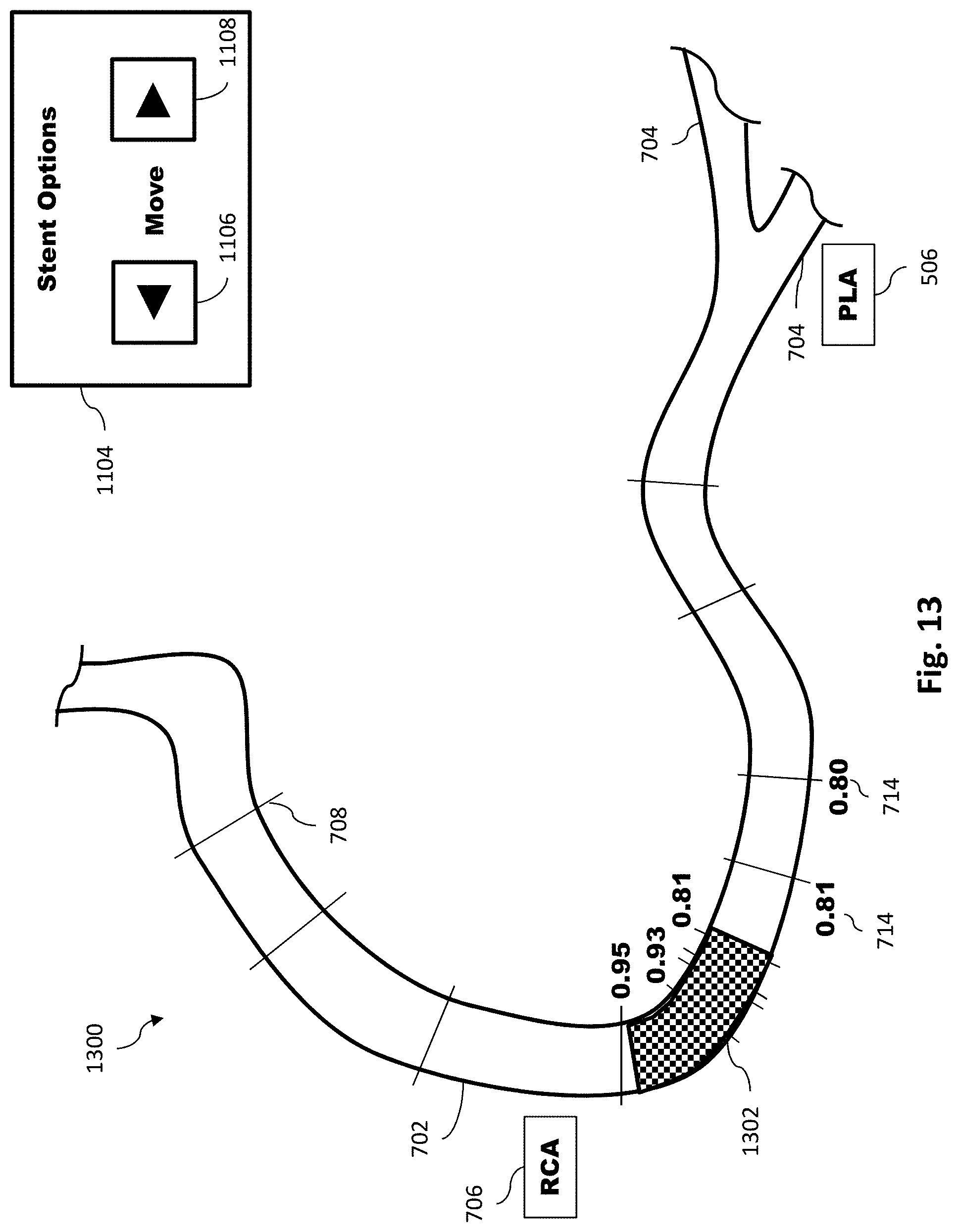 Patent US11779286 Figure 14 – Percutaneous coronary intervention (PCI) planning interface with pressure data and vessel data and associated devices, systems, and methods