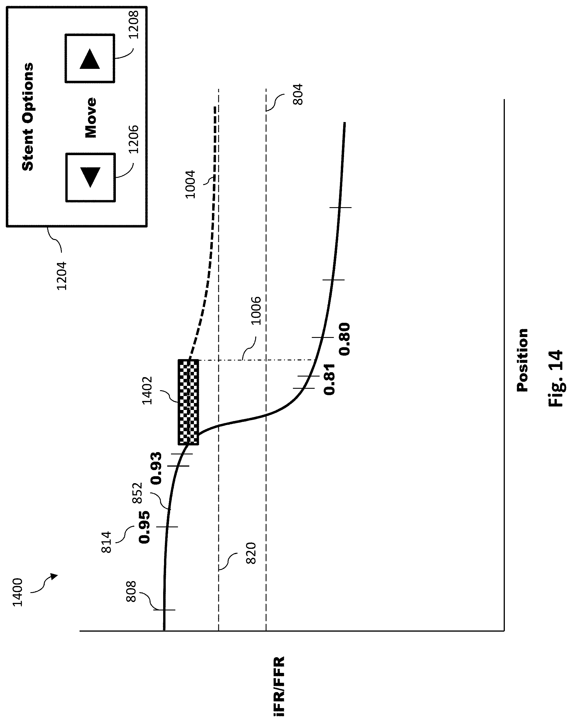 Patent US11779286 Figure 15 – Percutaneous coronary intervention (PCI) planning interface with pressure data and vessel data and associated devices, systems, and methods