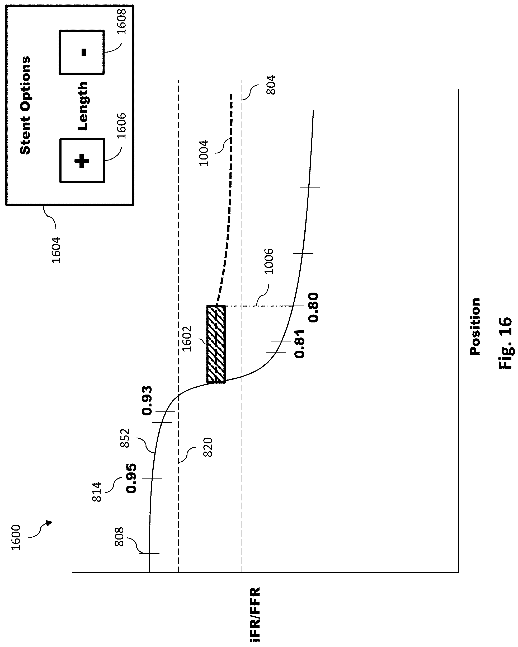 Patent US11779286 Figure 17 – Percutaneous coronary intervention (PCI) planning interface with pressure data and vessel data and associated devices, systems, and methods