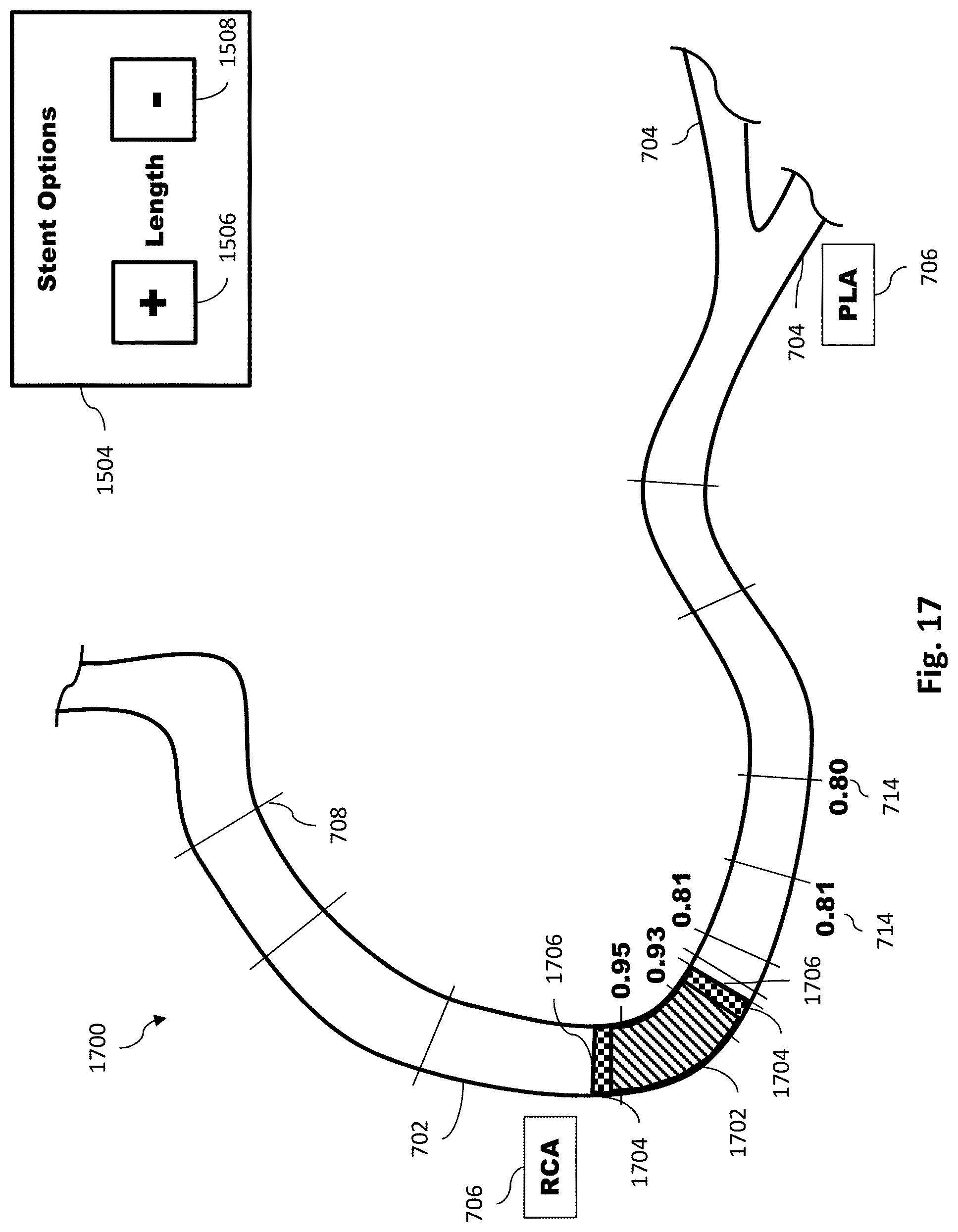 Patent US11779286 Figure 18 – Percutaneous coronary intervention (PCI) planning interface with pressure data and vessel data and associated devices, systems, and methods