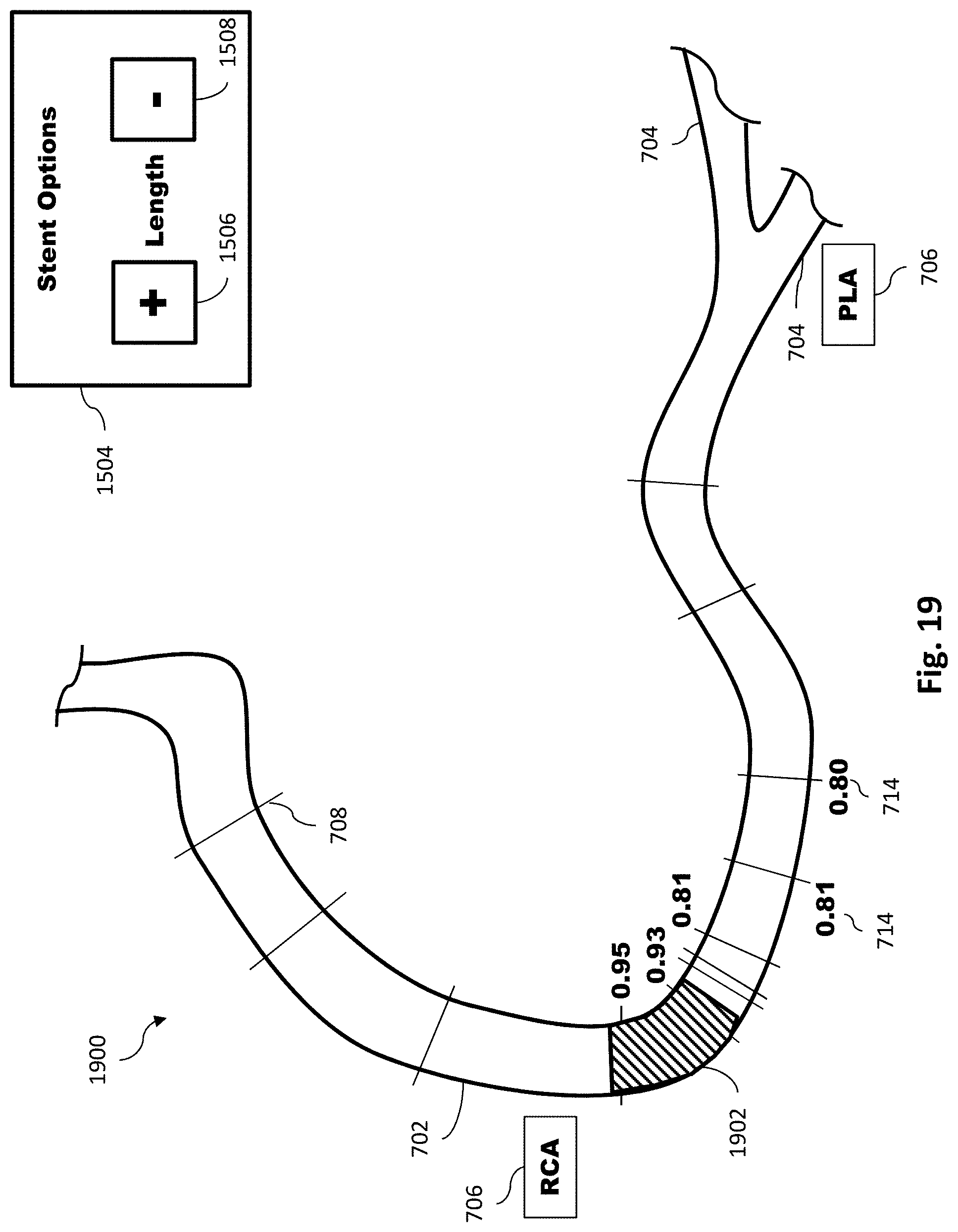 Patent US11779286 Figure 20 – Percutaneous coronary intervention (PCI) planning interface with pressure data and vessel data and associated devices, systems, and methods