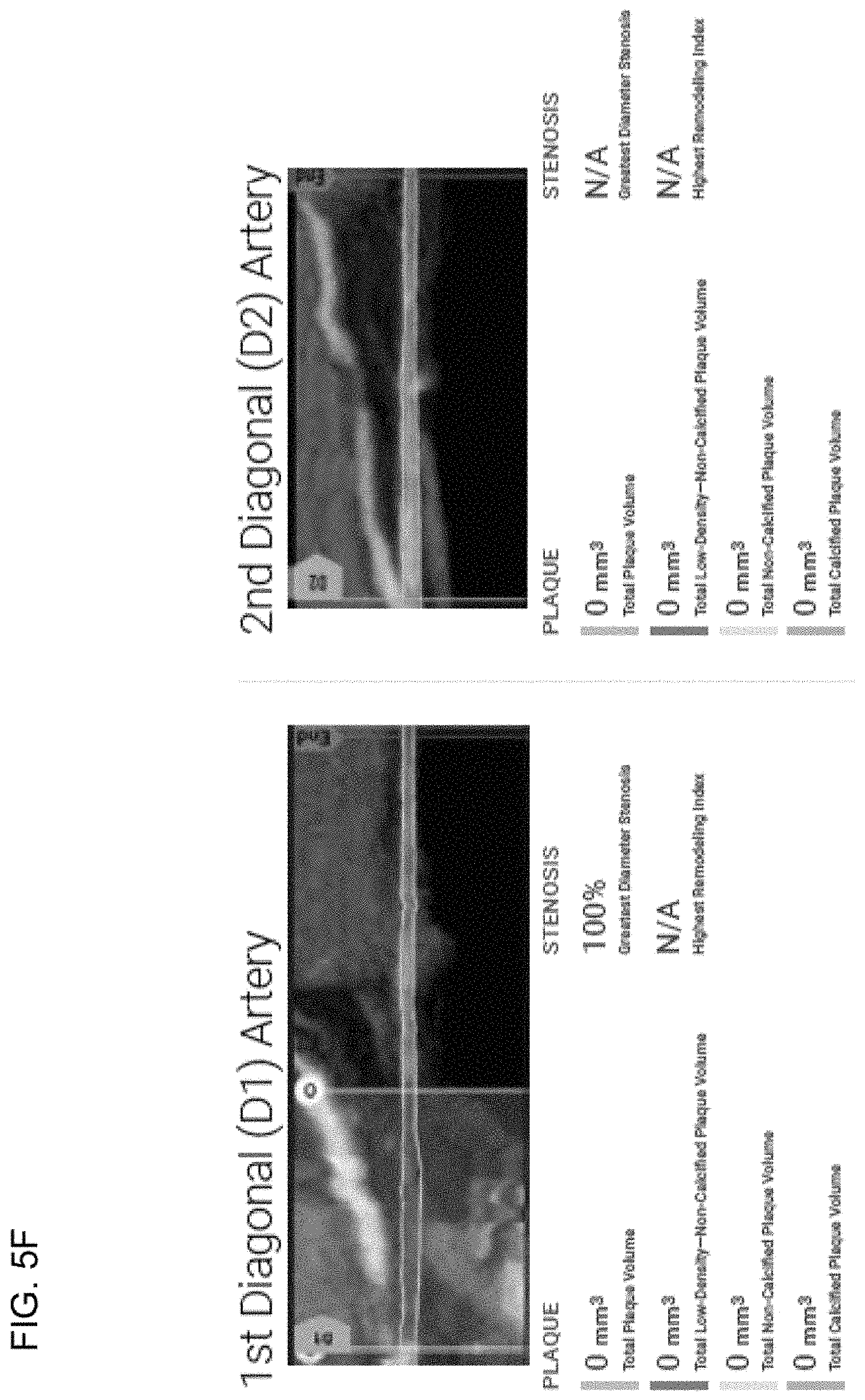 Patent US11779292 Figure 16 – Systems, methods, and devices for medical image analysis, diagnosis, risk stratification, decision making and/or disease tracking