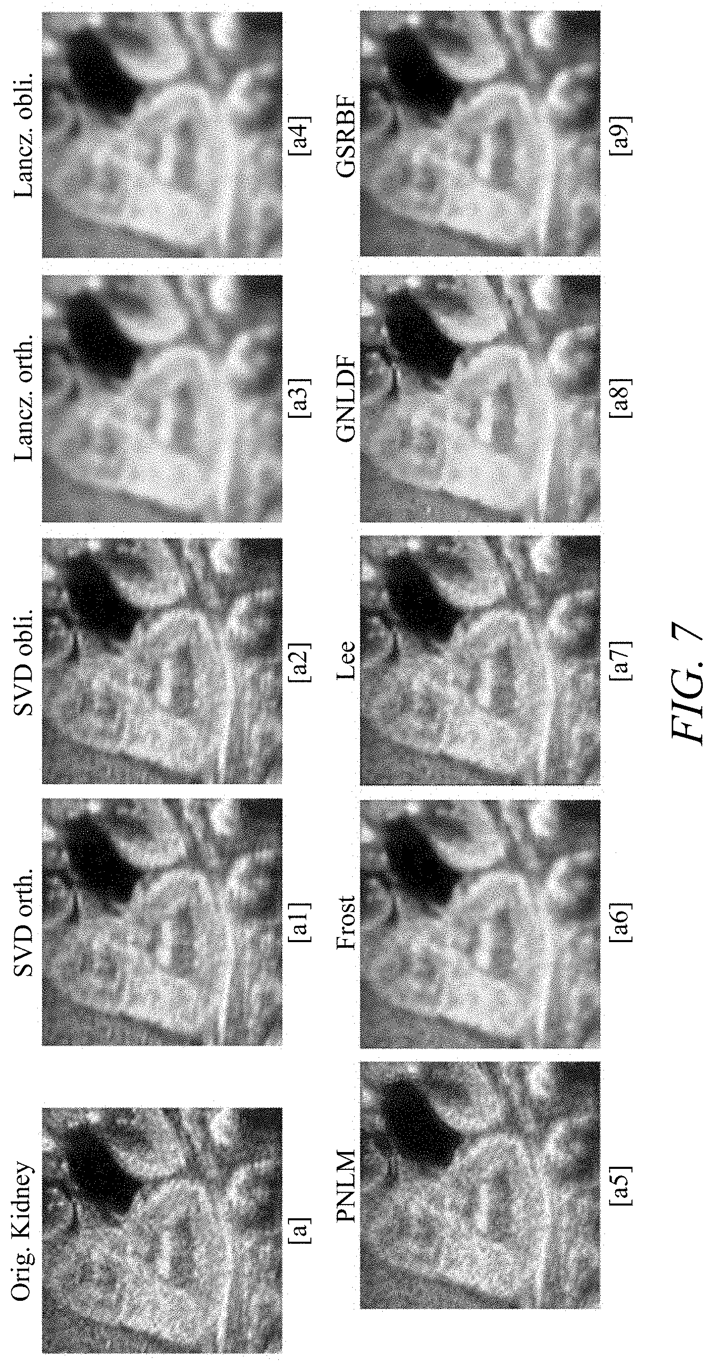 Patent US11779313 Figure 11 – Suppressing speckle noise in medical ultrasound images