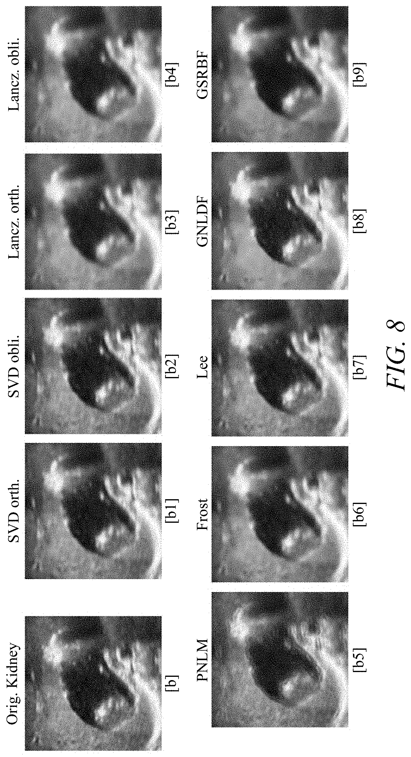 Patent US11779313 Figure 12 – Suppressing speckle noise in medical ultrasound images