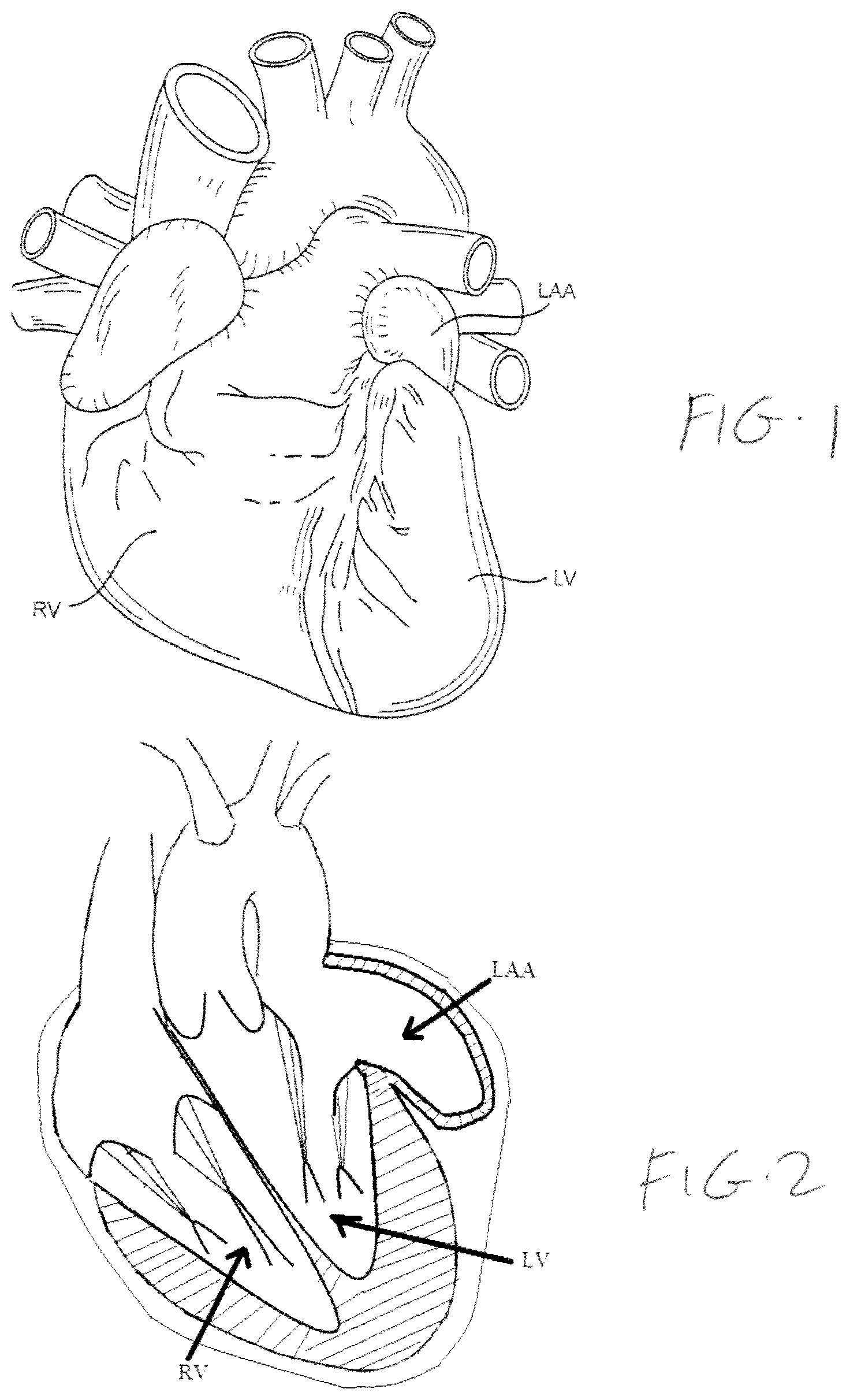 Patent US11779319 Figure 1 – Method and device for left atrial appendage closure