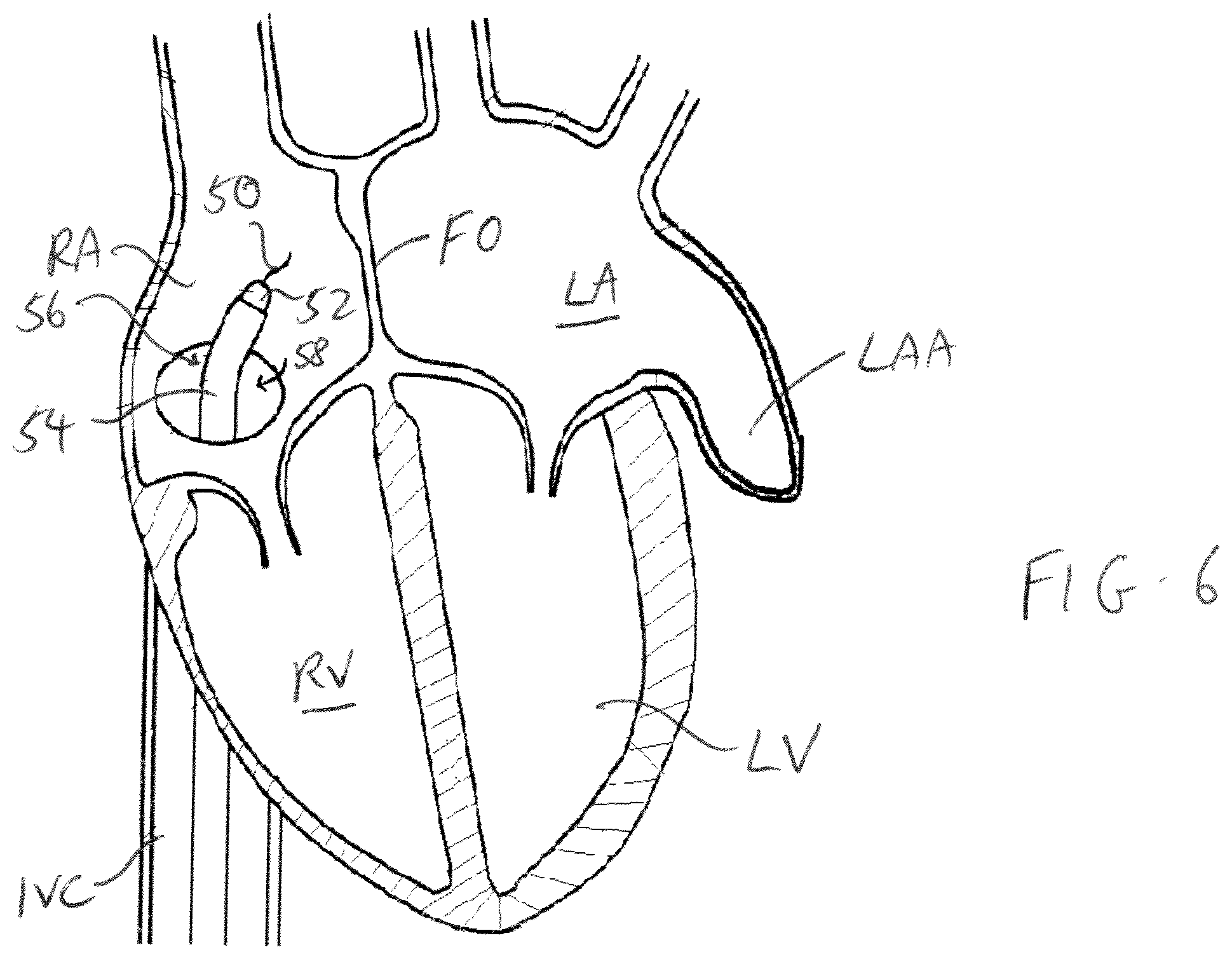 Patent US11779319 Figure 3 – Method and device for left atrial appendage closure