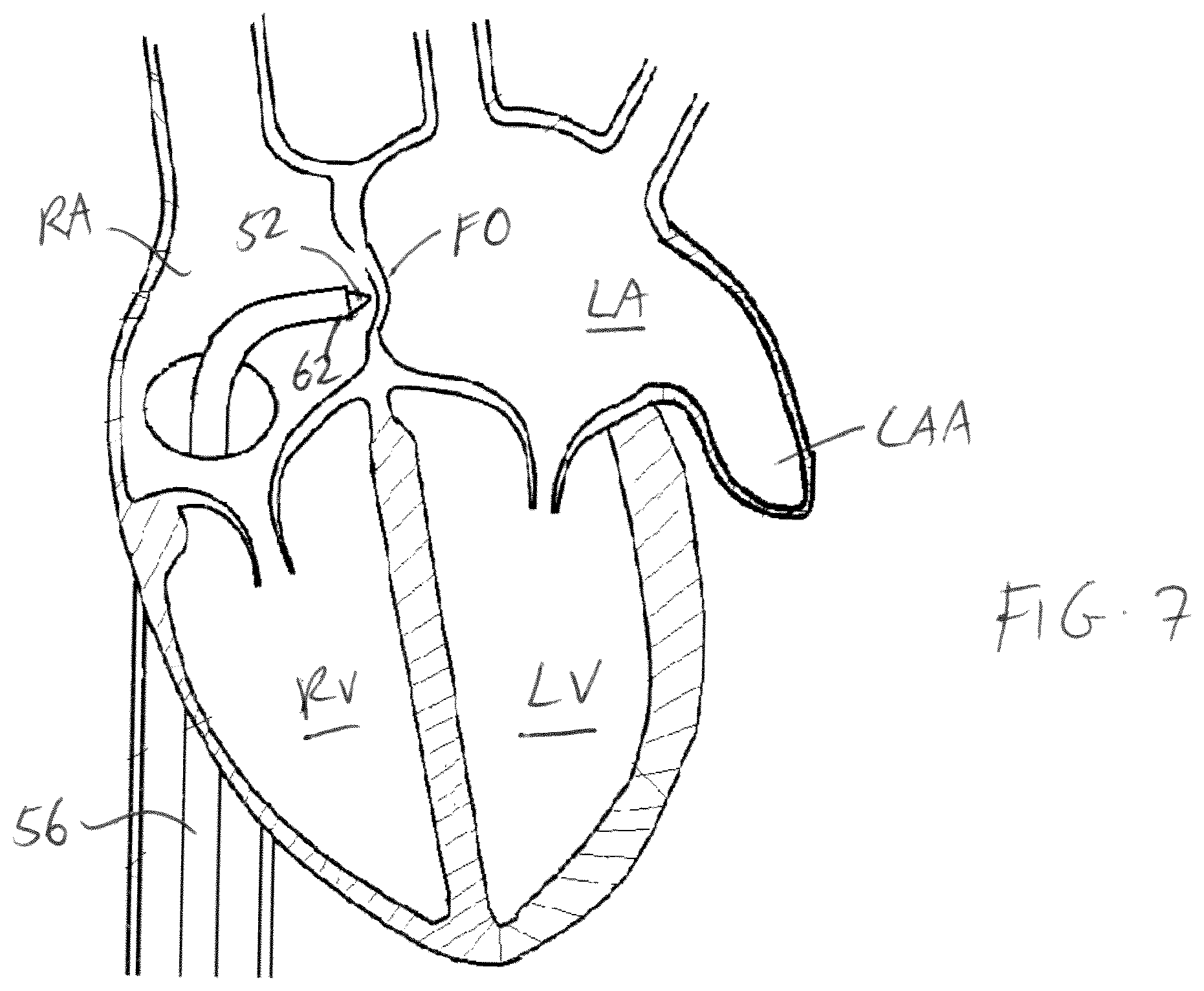 Patent US11779319 Figure 4 – Method and device for left atrial appendage closure