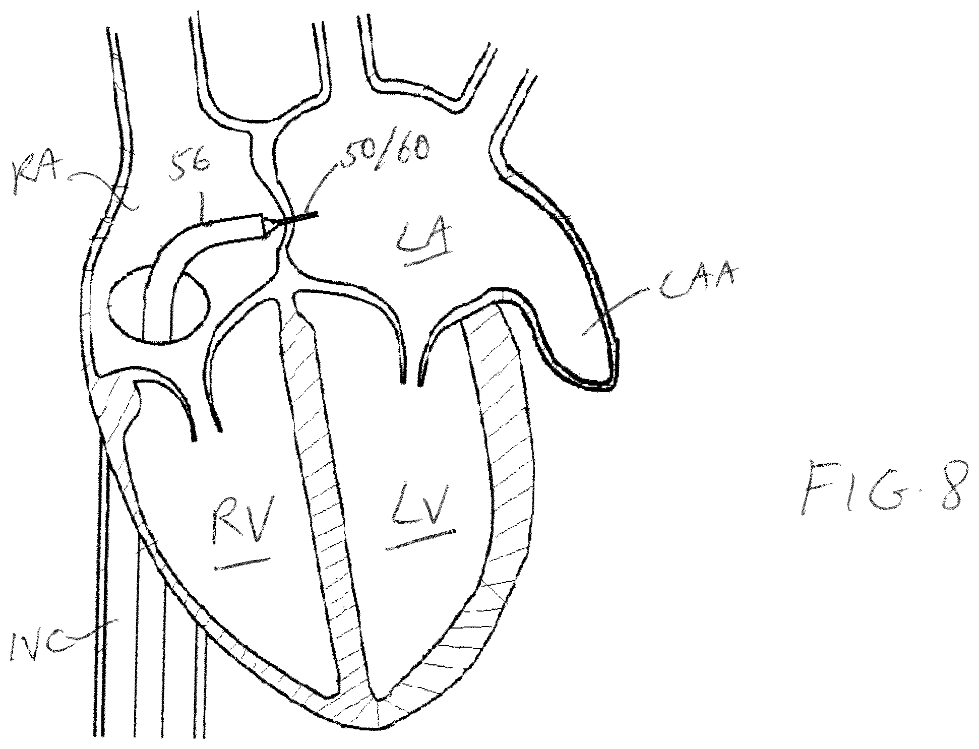 Patent US11779319 Figure 5 – Method and device for left atrial appendage closure