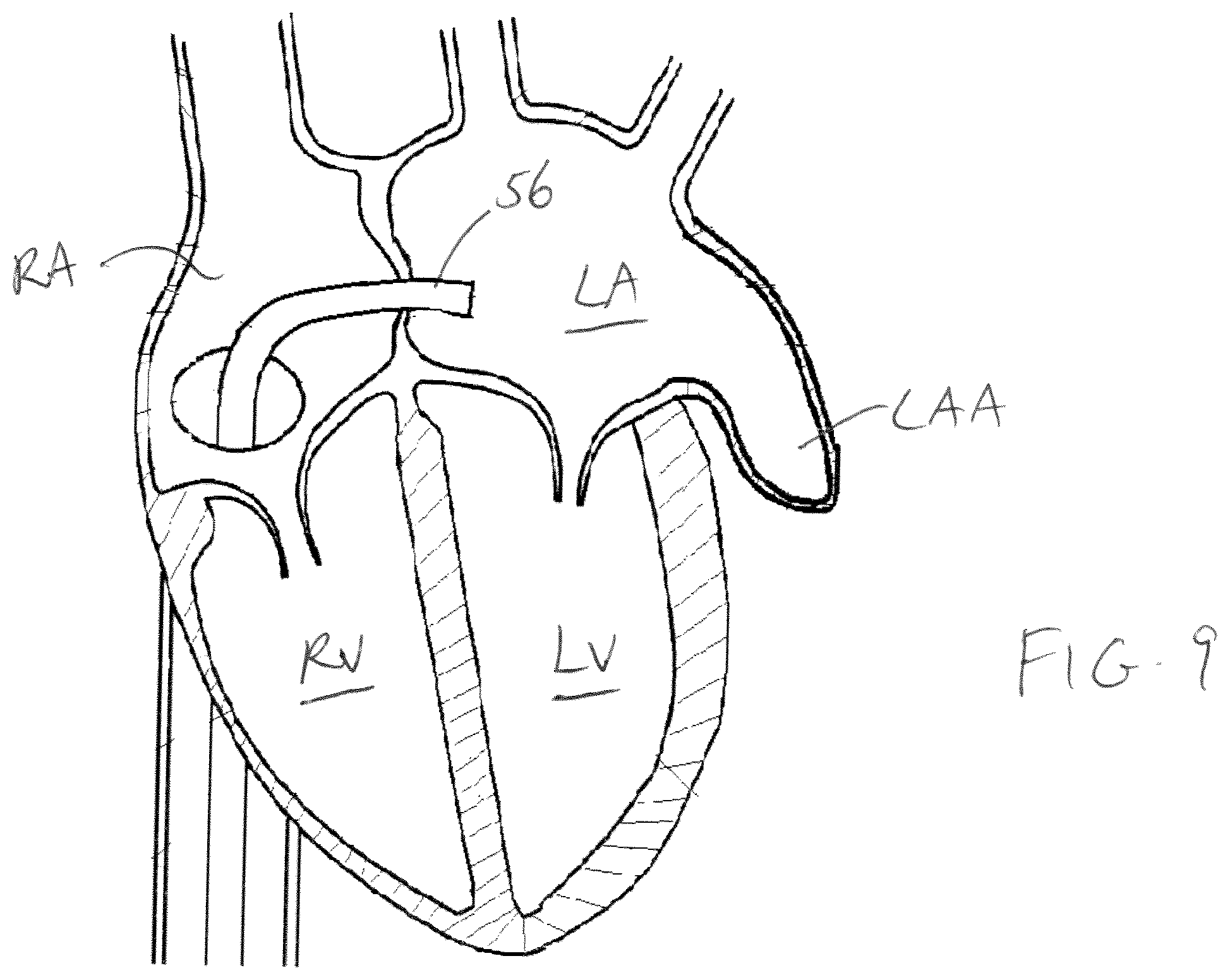 Patent US11779319 Figure 6 – Method and device for left atrial appendage closure