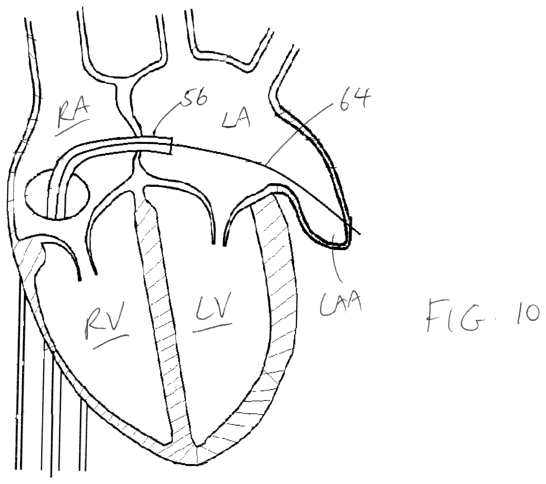 Patent US11779319 Figure 7 – Method and device for left atrial appendage closure