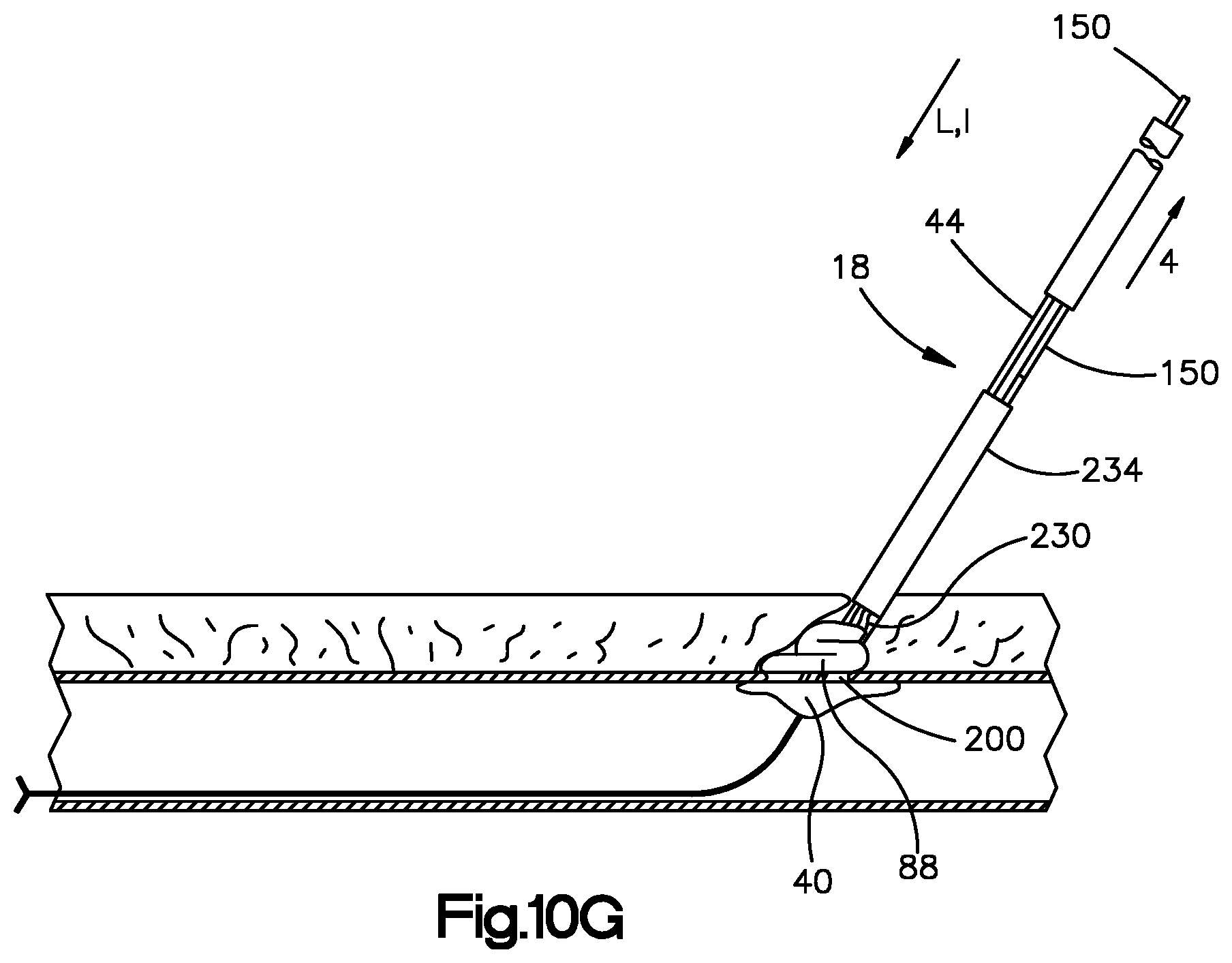 Patent US11779320 Figure 14 – Vascular closure device