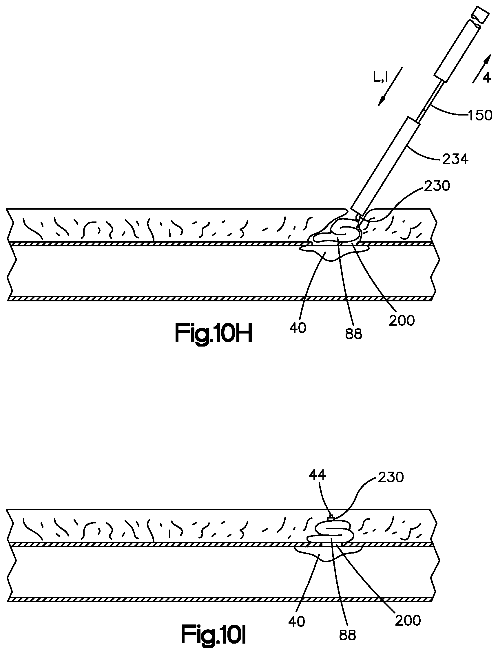 Patent US11779320 Figure 15 – Vascular closure device