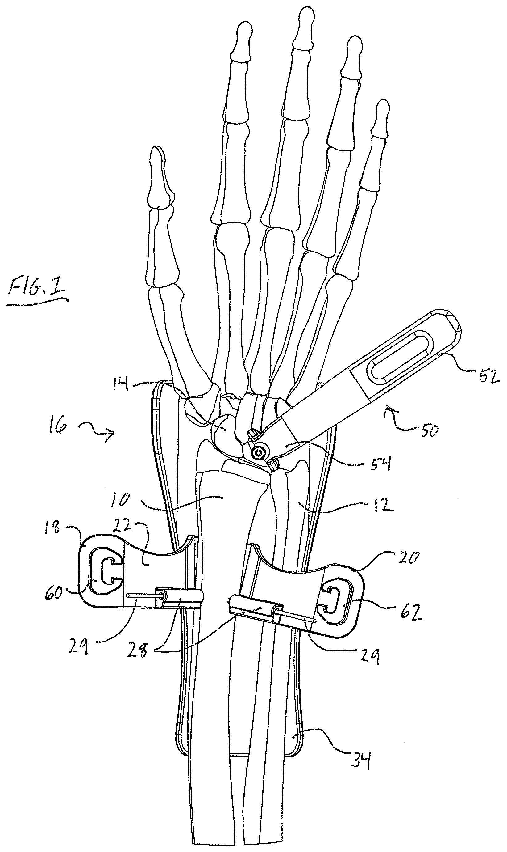 Patent US11779323 Figure 1 – Single use radiolucent stabilizing retractor system
