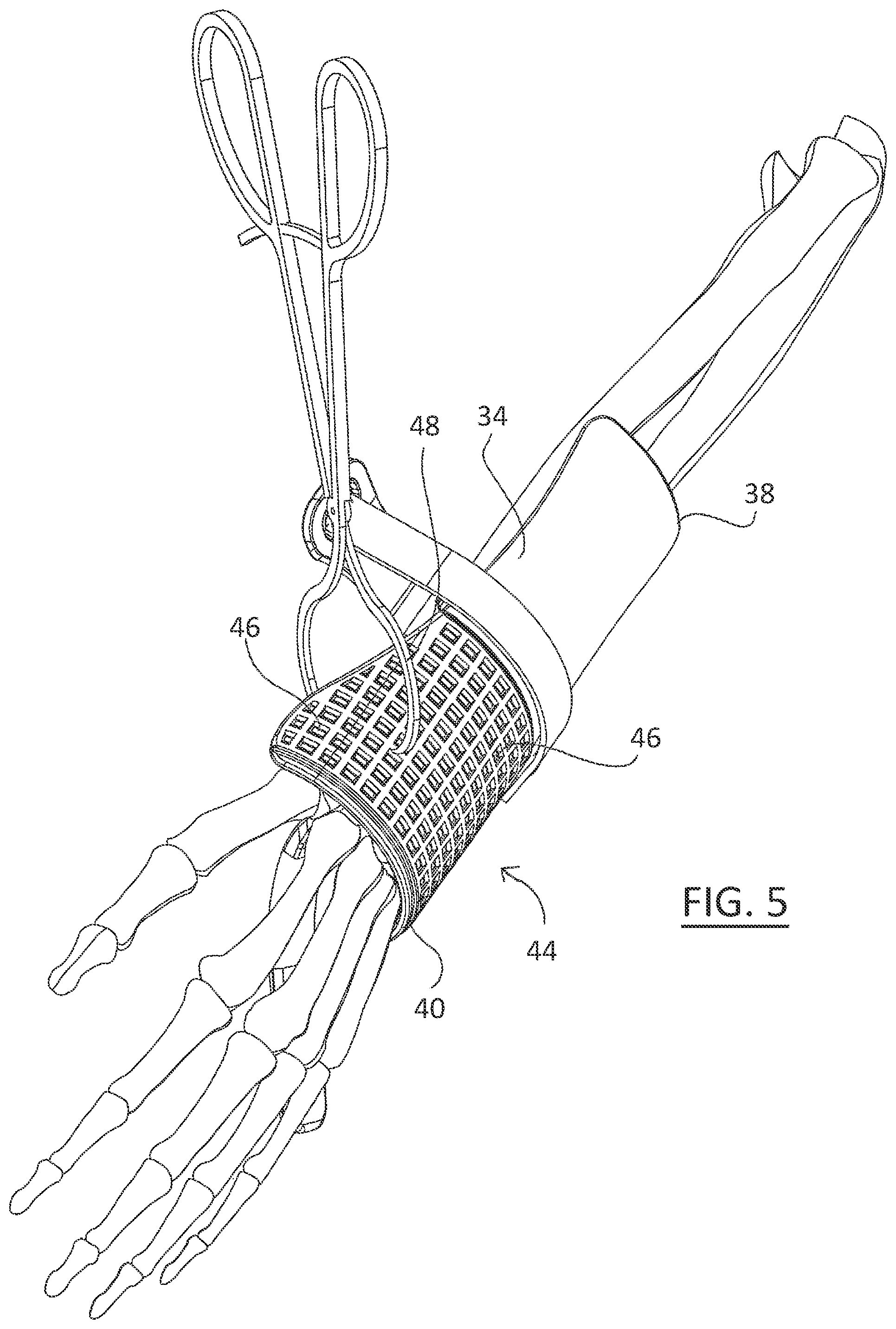 Patent US11779323 Figure 5 – Single use radiolucent stabilizing retractor system
