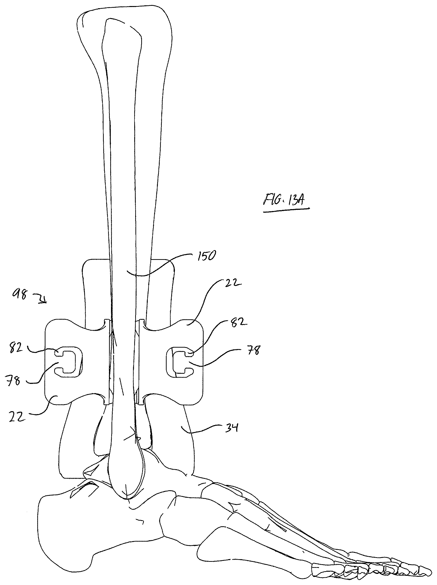 Patent US11779323 Figure 15 – Single use radiolucent stabilizing retractor system
