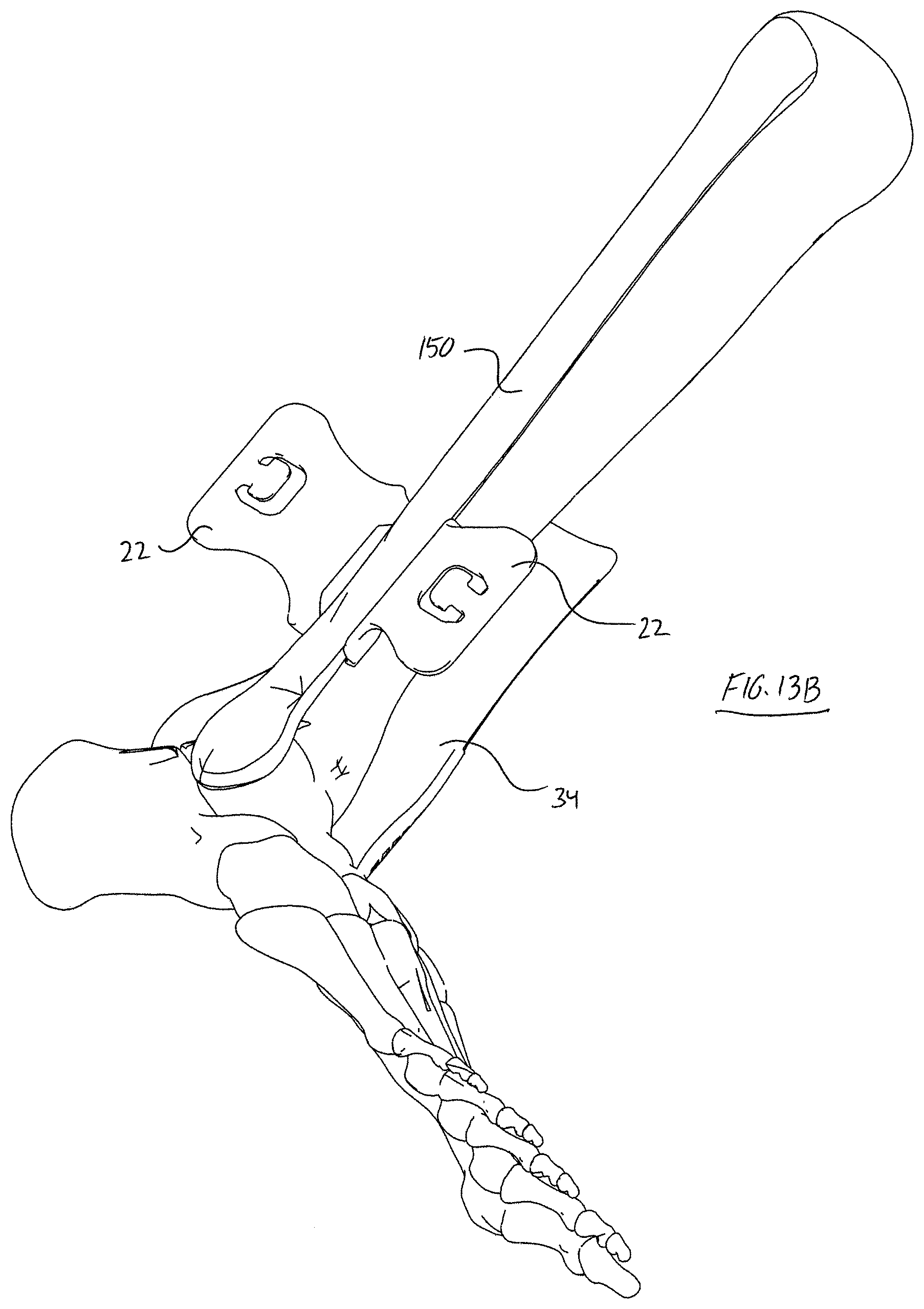 Patent US11779323 Figure 16 – Single use radiolucent stabilizing retractor system