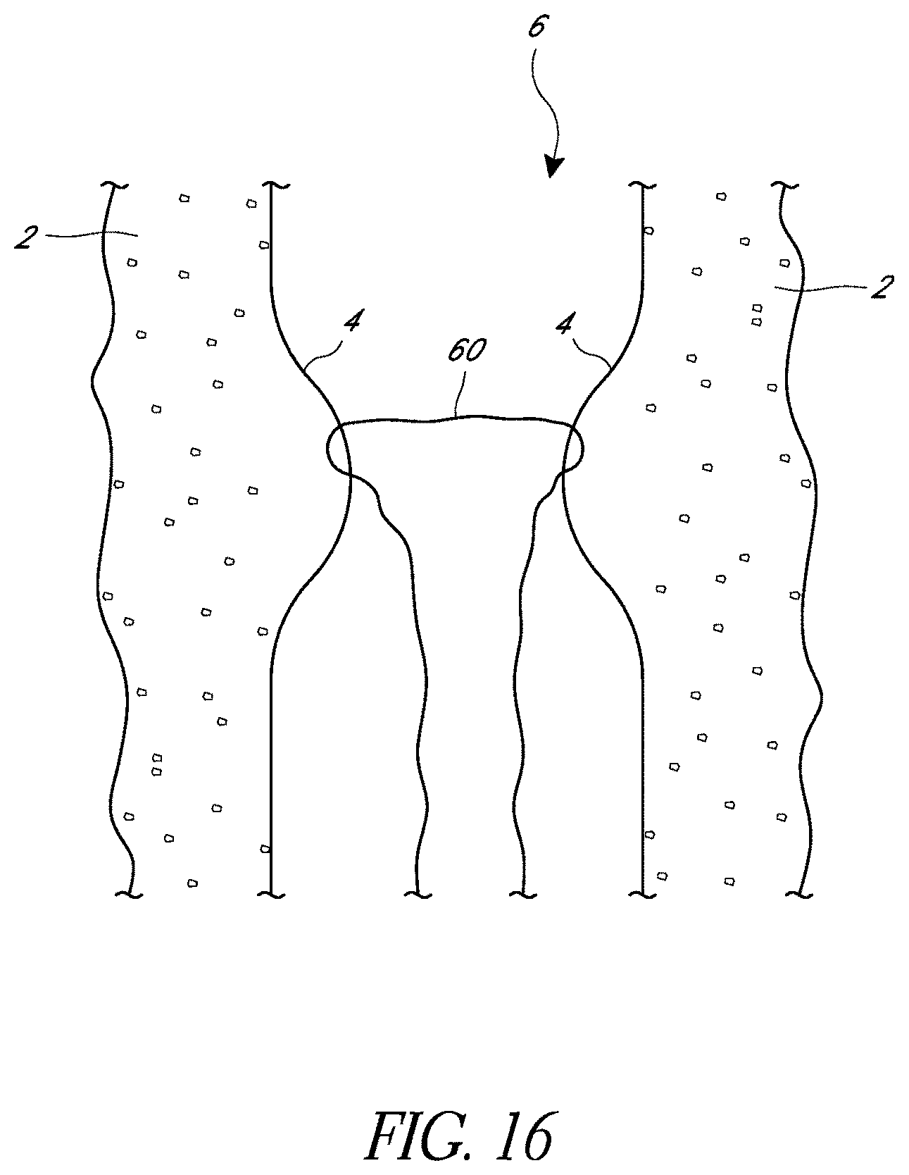 Patent US11779324 Figure 16 – Suturing methods and apparatuses