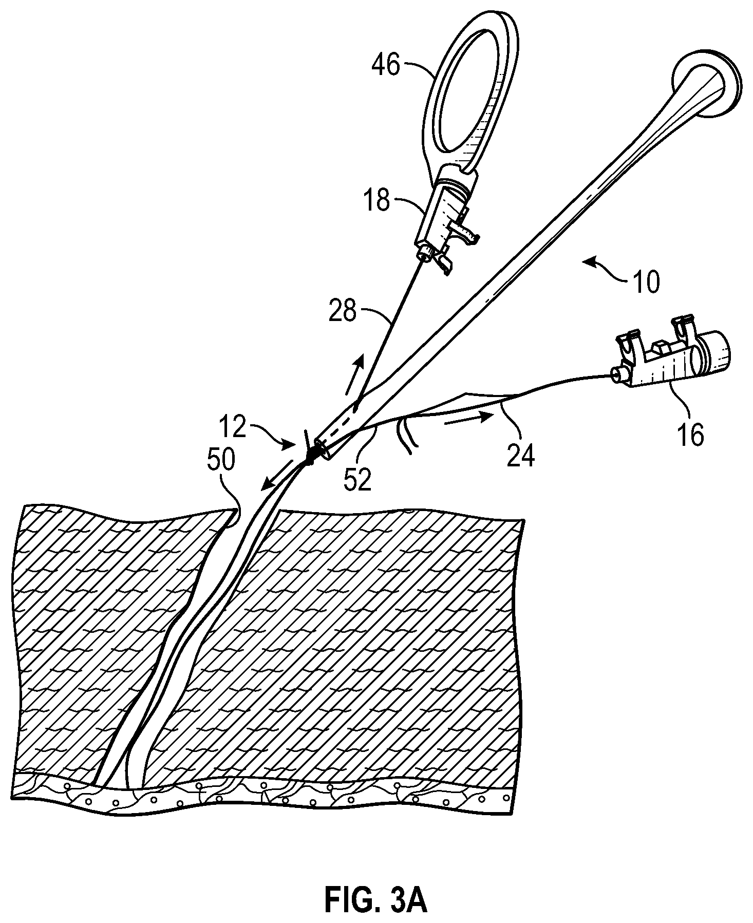 Patent US11779325 Figure 4 – Knot delivery device