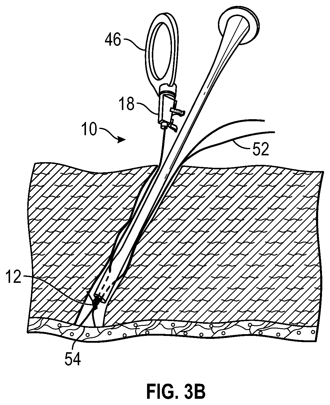 Patent US11779325 Figure 5 – Knot delivery device