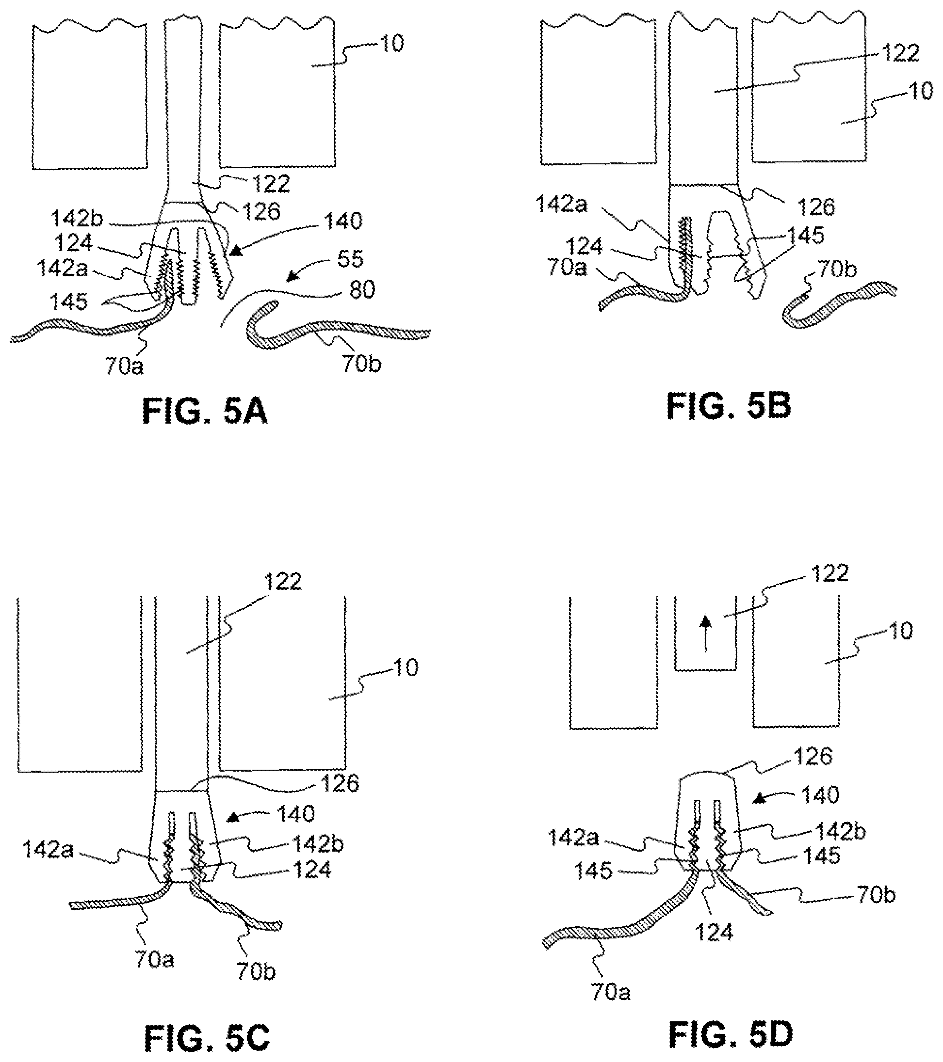 Patent US11779338 Figure 6 – Devices for approximating tissue and related