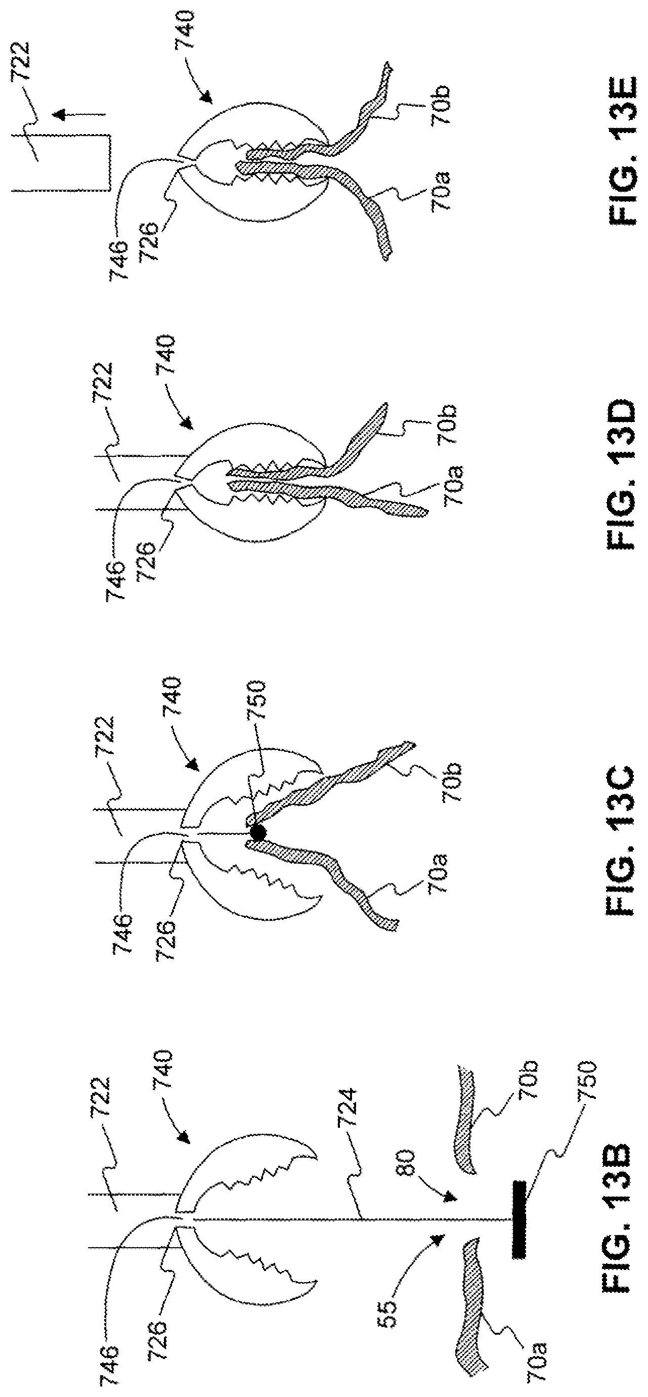 Patent US11779338 Figure 17 – Devices for approximating tissue and related