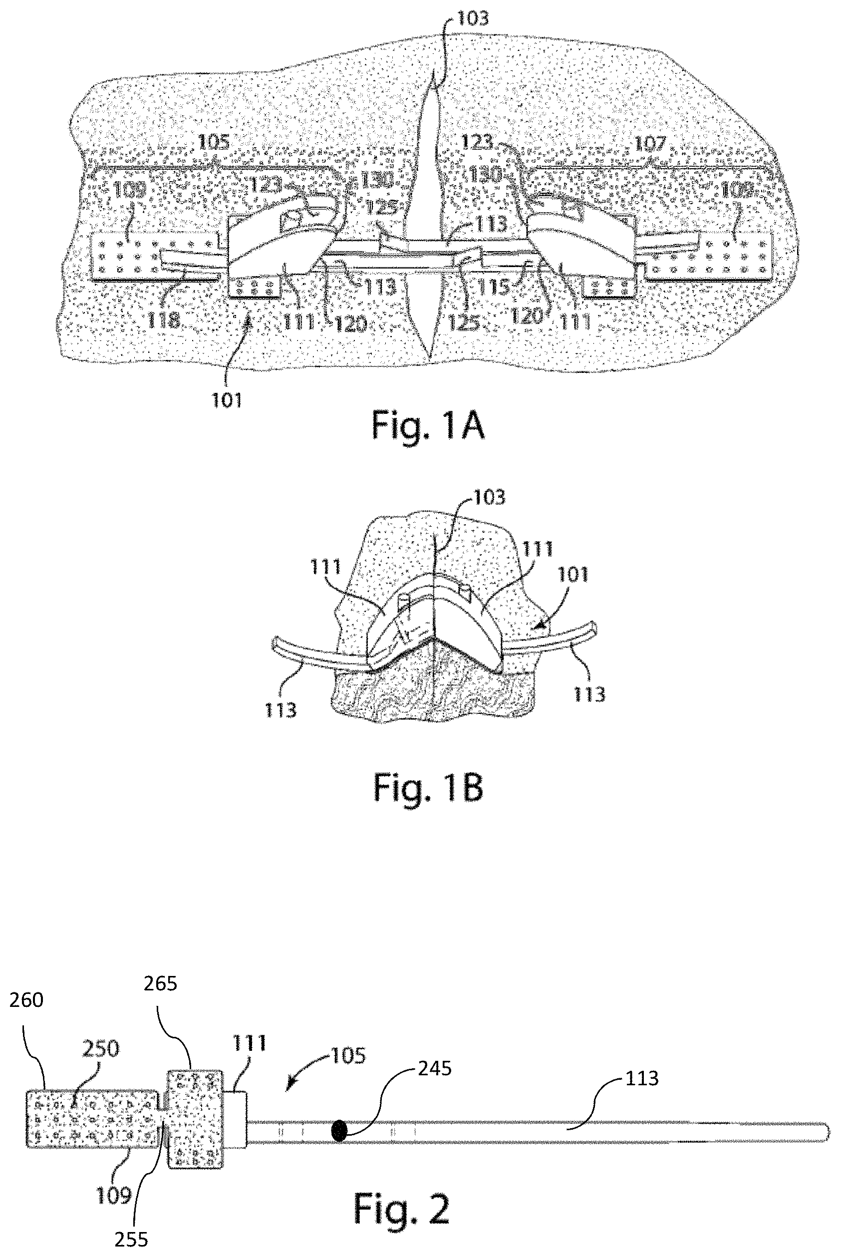 Patent US11779339 — Non-invasive wound closure device — Figure 1